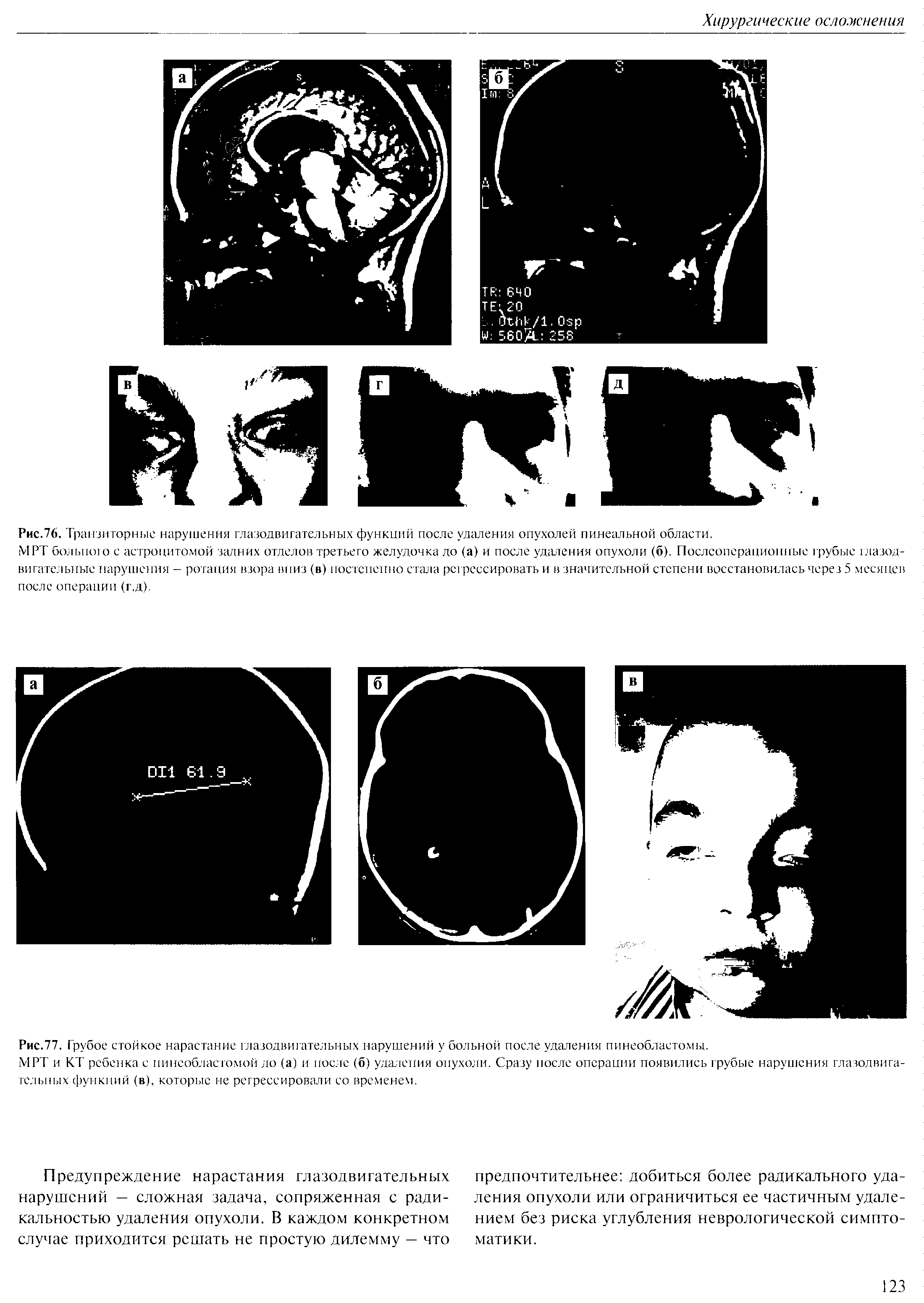 Рис.76. Транзиторные нарушения глазодвигательных функций после удаления опухолей пинеальной области.