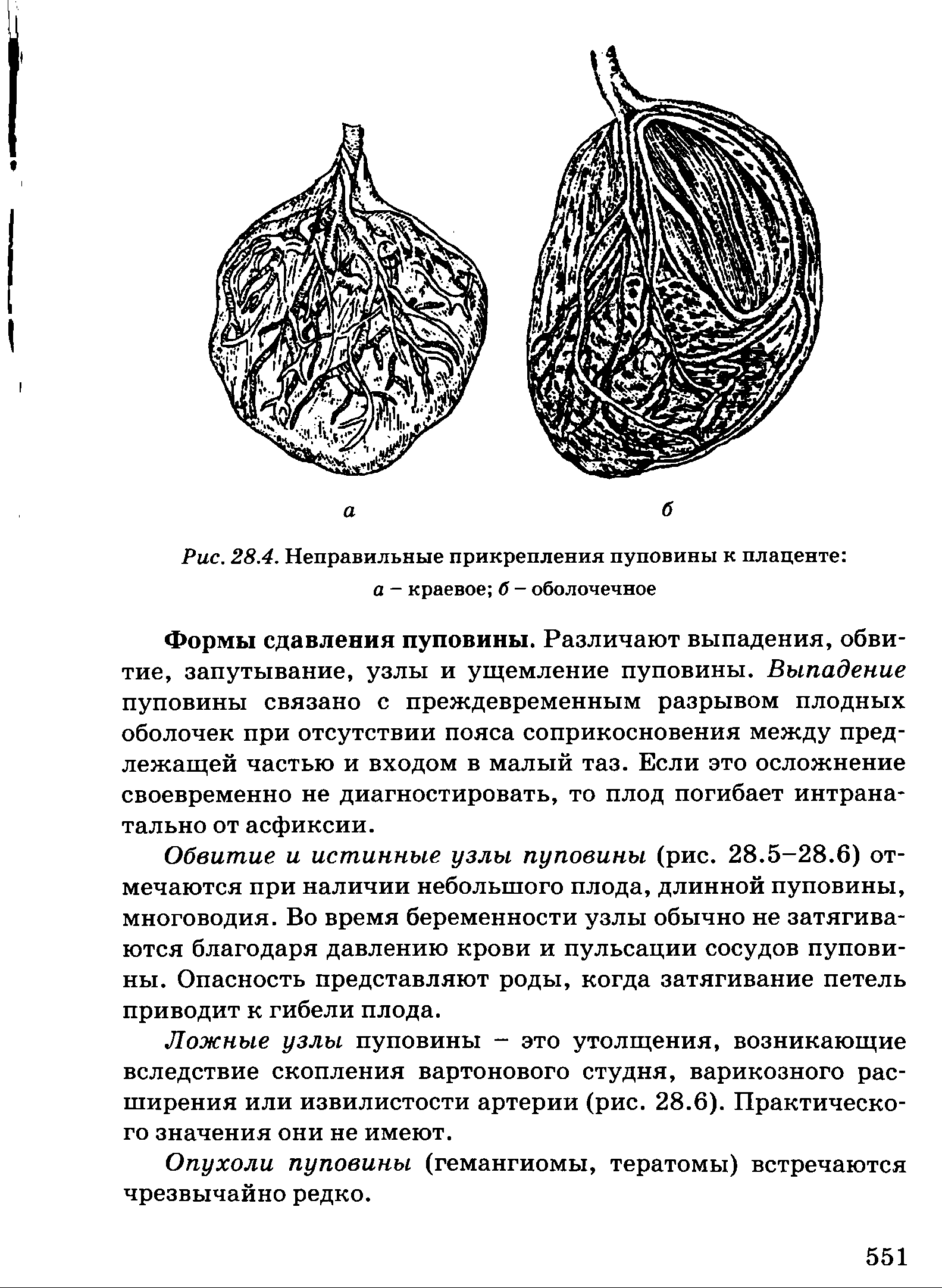 Рис. 28.4. Неправильные прикрепления пуповины к плаценте а - краевое б - оболочечное...