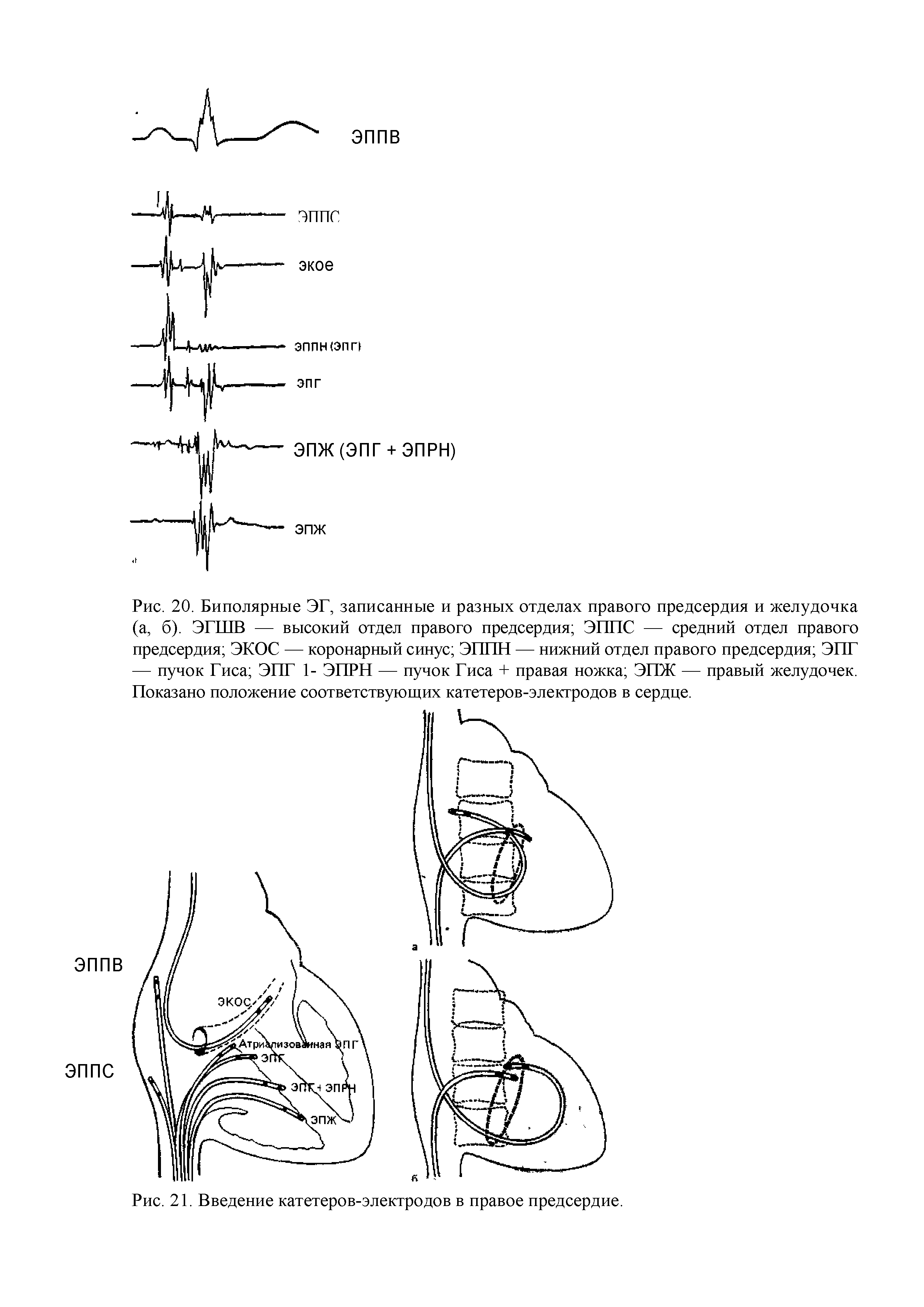 Рис. 20. Биполярные ЭГ, записанные и разных отделах правого предсердия и желудочка (а, б). ЭГШВ — высокий отдел правого предсердия Э1П1С — средний отдел правого предсердия ЭКОС — коронарный синус Э1П1Н — нижний отдел правого предсердия ЭПГ — пучок Гиса ЭПГ 1- ЭПРН — пучок Гиса + правая ножка ЭПЖ — правый желудочек. Показано положение соответствующих катетеров-электродов в сердце.