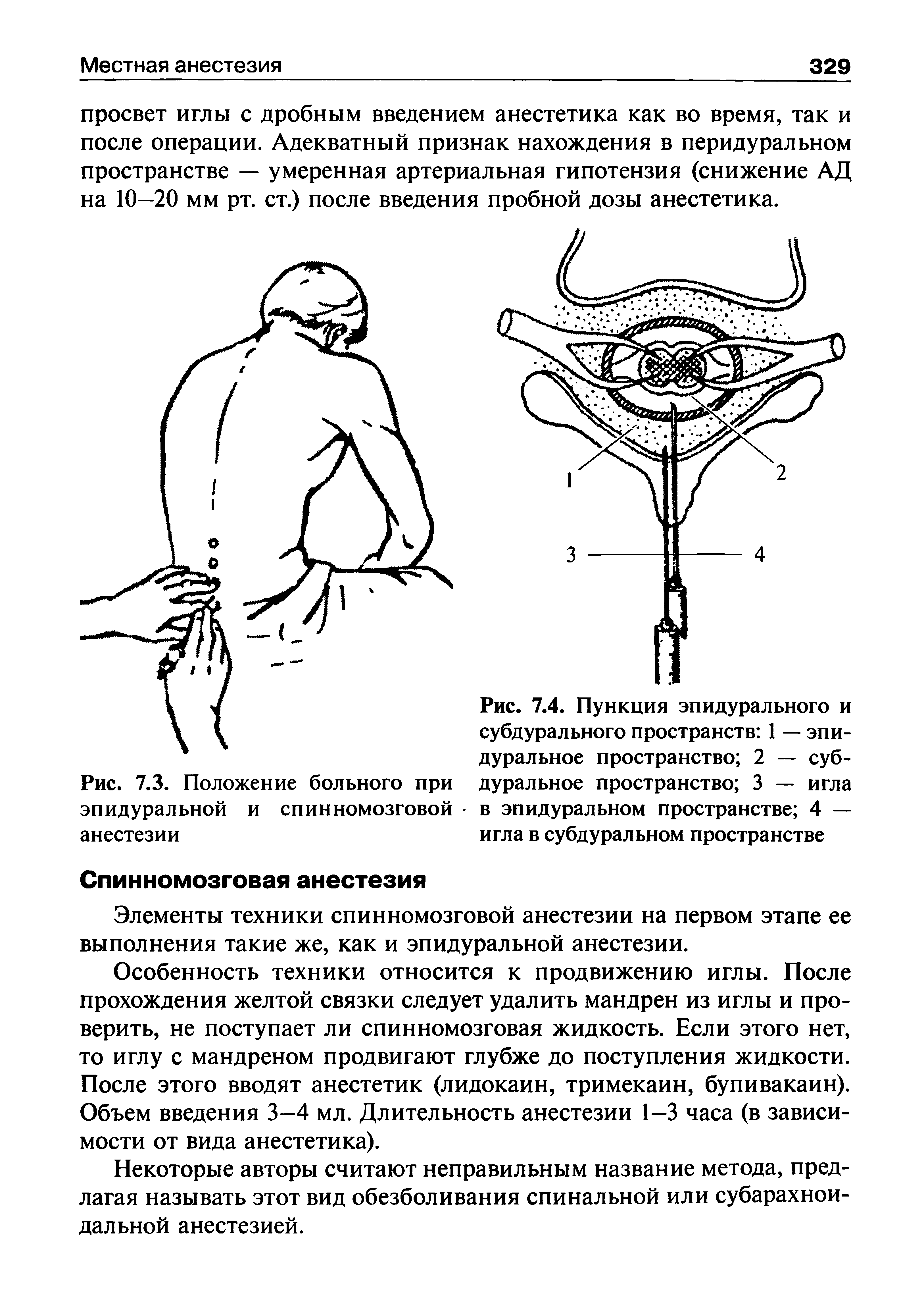 Рис. 7.4. Пункция эпидурального и субдурального пространств 1 — эпидуральное пространство 2 — субдуральное пространство 3 — игла в эпидуральном пространстве 4 — игла в субдуральном пространстве...