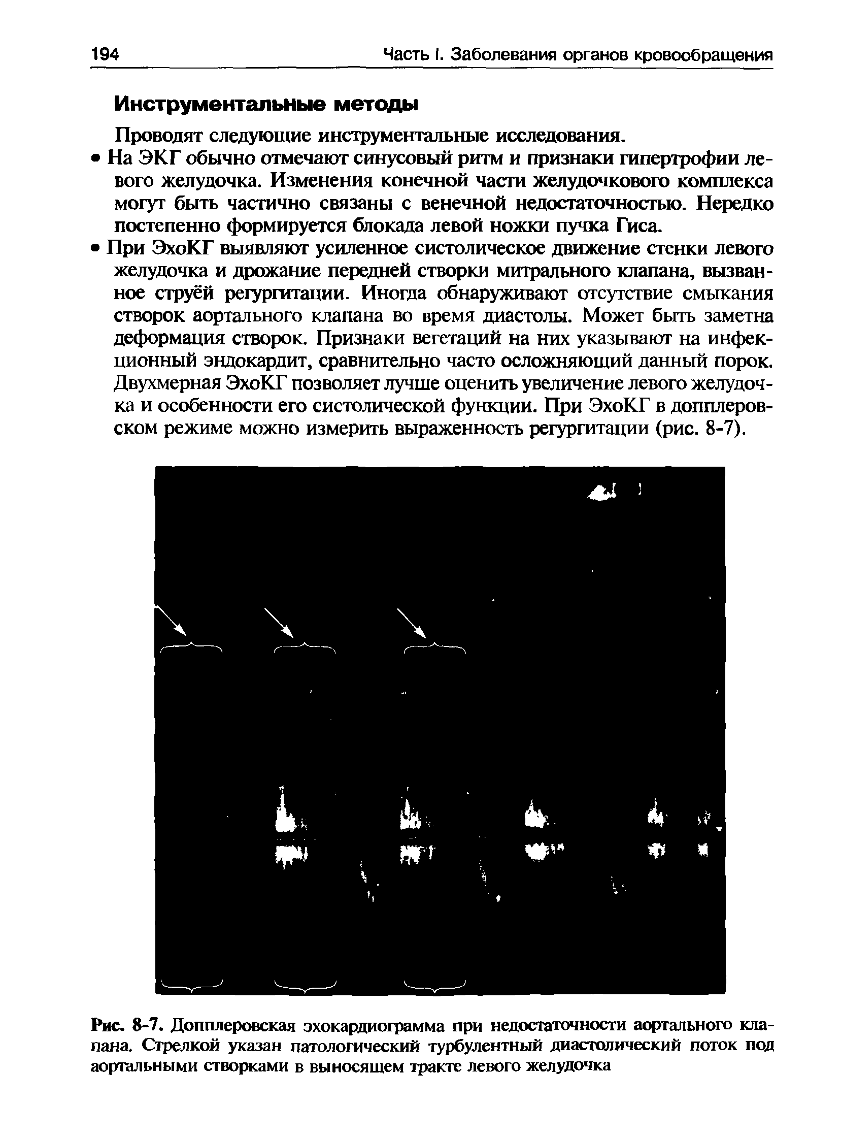 Рис. 8-7. Допплеровская эхокардиограмма при недостаточности аортального клапана. Стрелкой указан патологический турбулентный диастолический поток под аортальными створками в выносящем тракте левого желудочка...