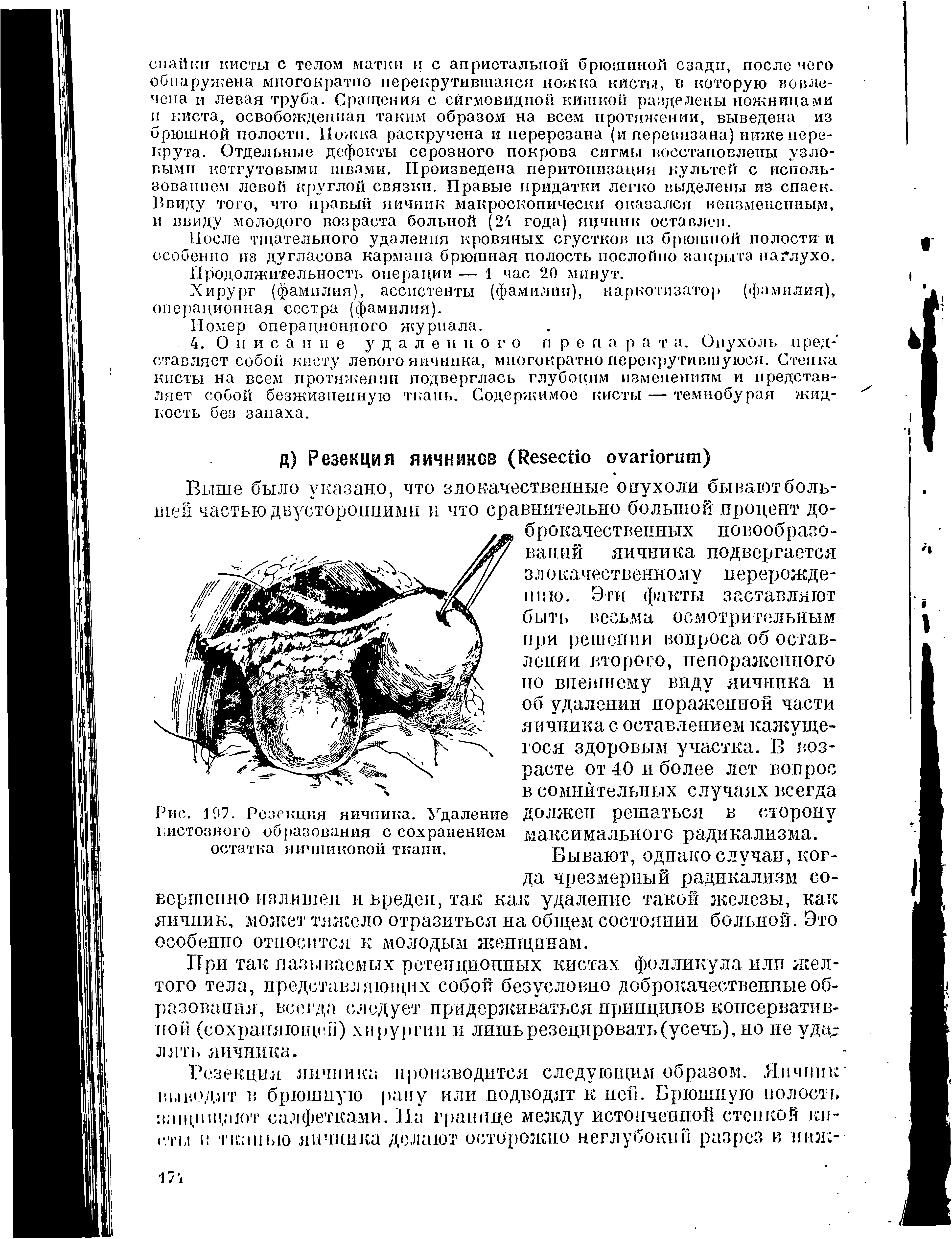 Рис. 197. Резекция яичника. Удаление кистозного образования с сохранением остатка яичниковой ткани.