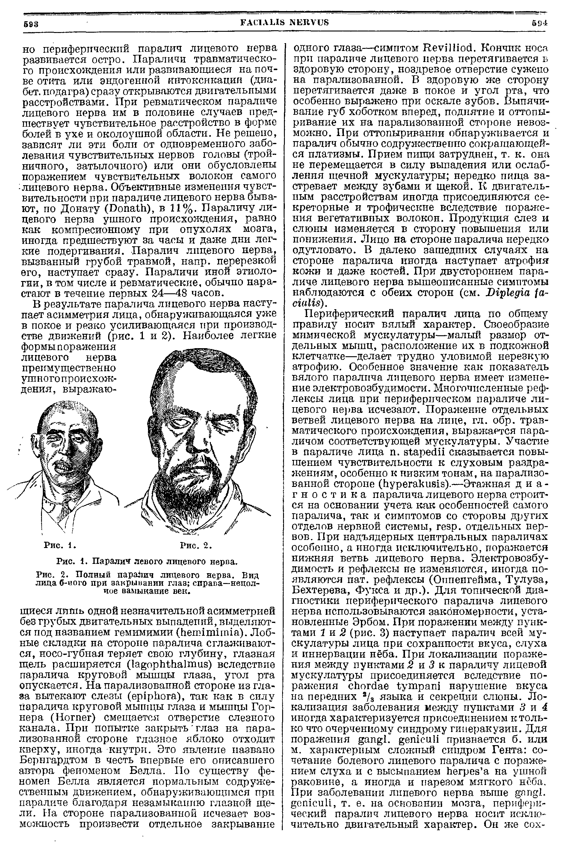 Рис. 2. Полный паралич лицевого нерва. Вид лица б-ного при закрывании глаз справа—неполное вамыкание век.