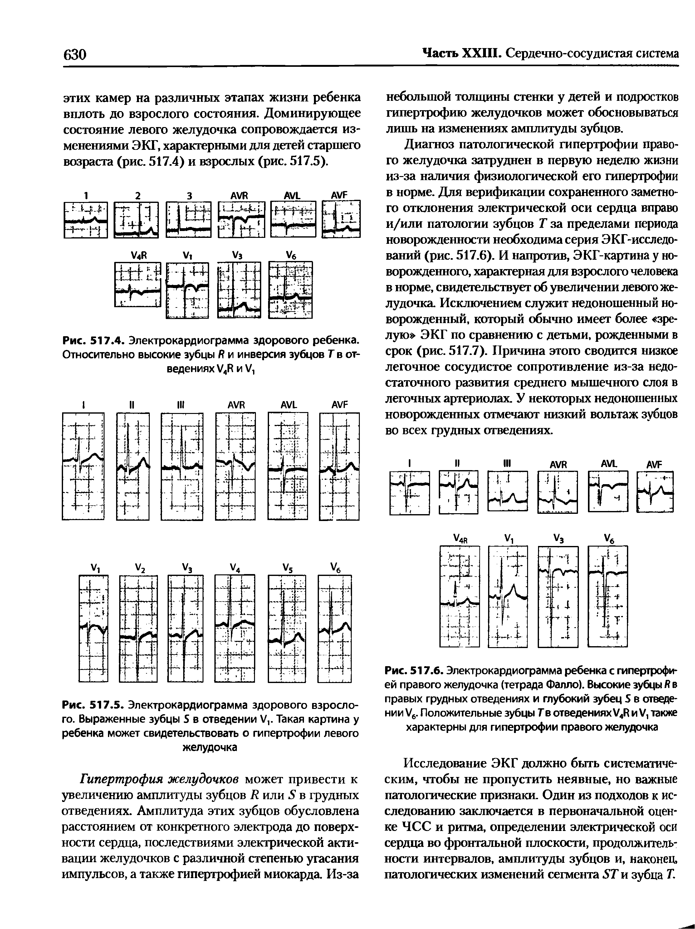 Рис. 517.4. Электрокардиограмма здорового ребенка. Относительно высокие зубцы Я и инверсия зубцов Т в отведениях /4Я и V,...