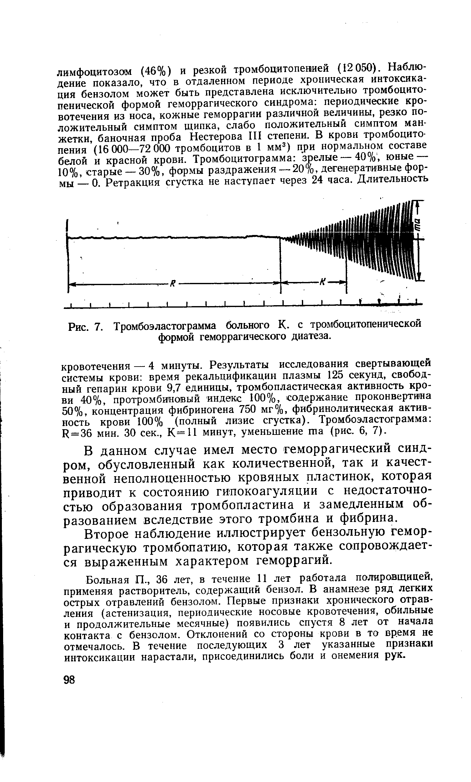 Рис. 7. Тромбоэластограмма больного К. с тромбоцитопенической формой геморрагического диатеза.