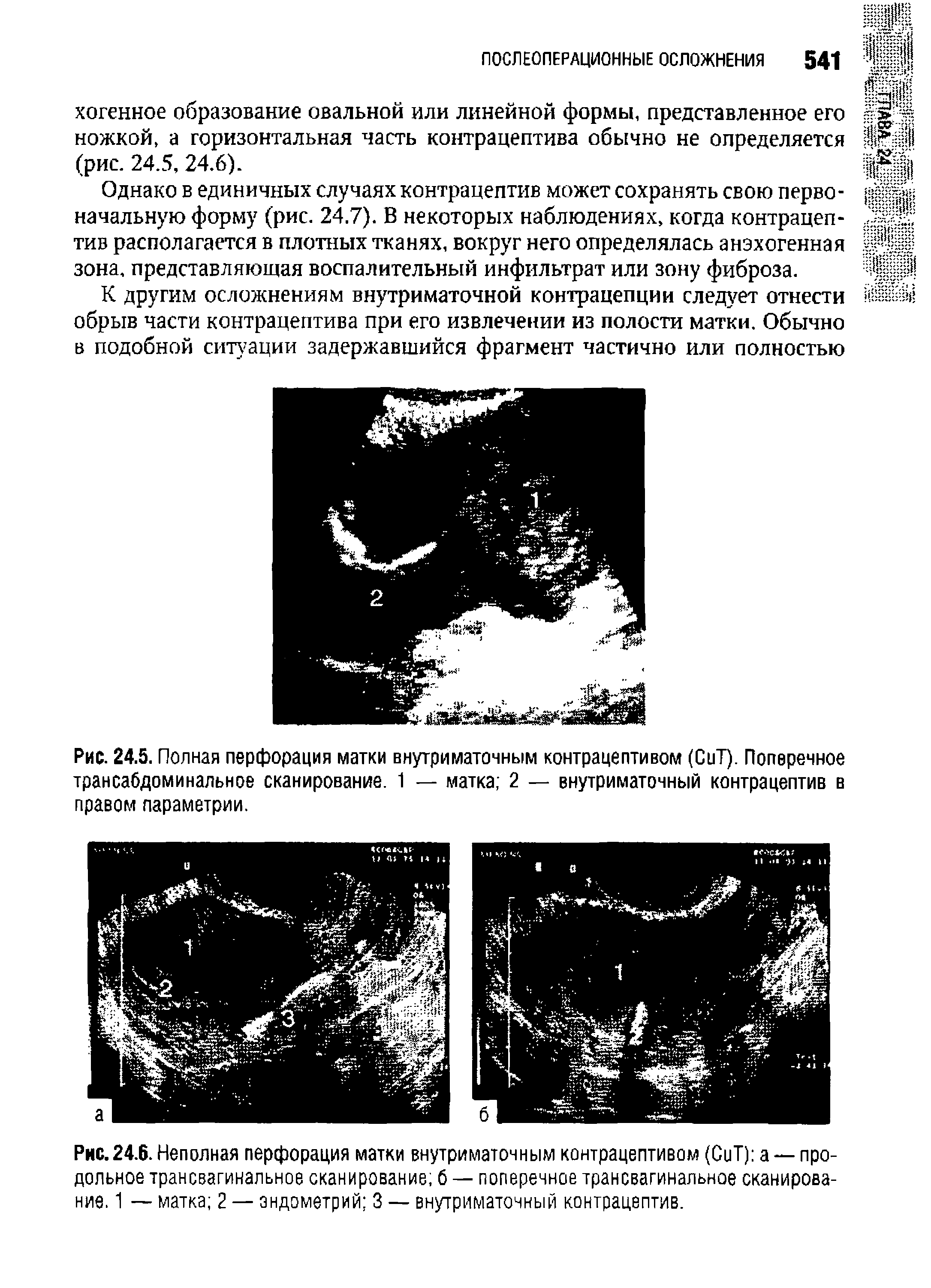 Рис.24.6. Неполная перфорация матки внутриматочным контрацептивом (СиТ) а —продольное трансвагинальное сканирование б — поперечное трансвагинальное сканирование. 1 — матка 2 — эндометрий 3 — внутриматочный контрацептив.