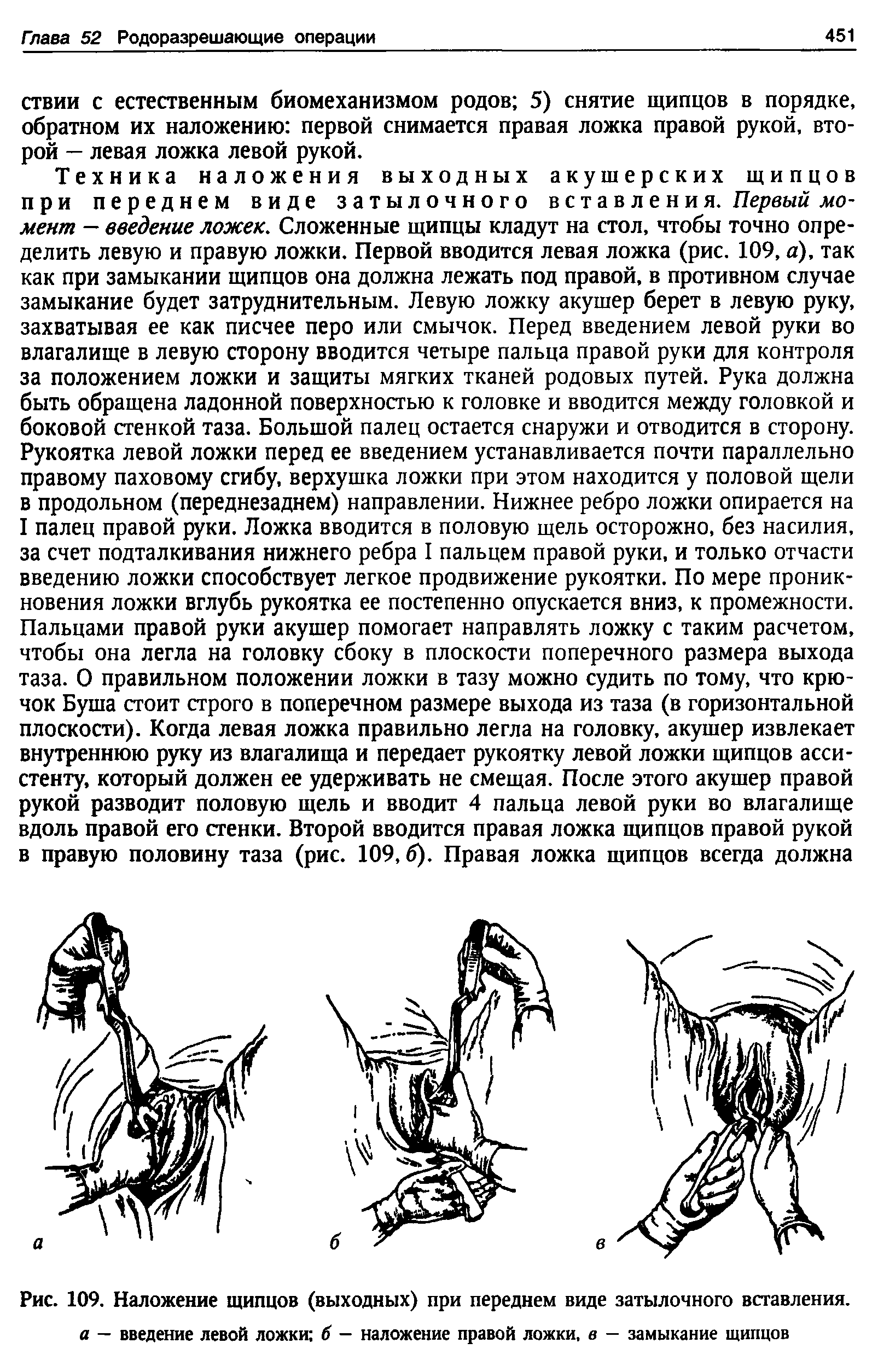 Рис. 109. Наложение щипцов (выходных) при переднем виде затылочного вставления. а — введение левой ложки б — наложение правой ложки, в — замыкание щипцов...