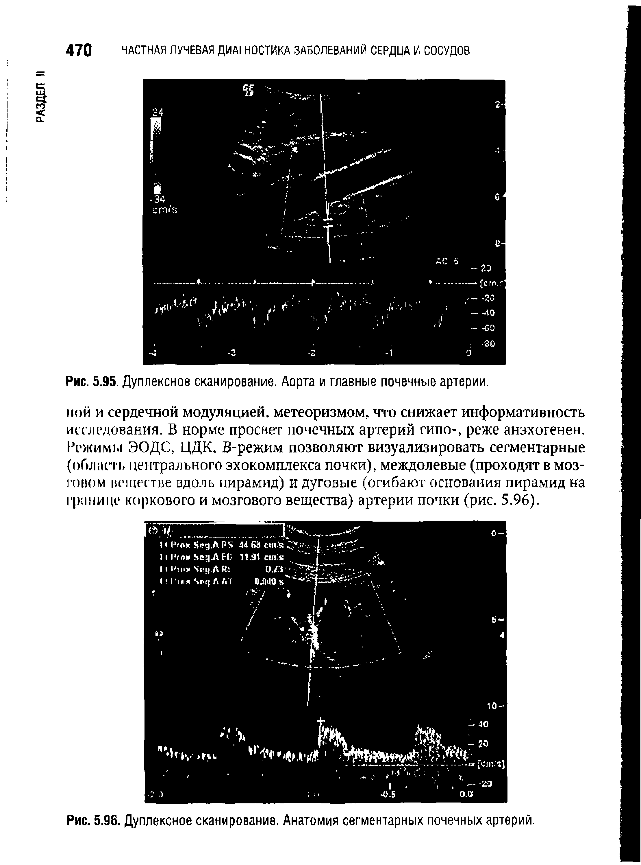 Рис. 5.96. Дуплексное сканирование. Анатомия сегментарных почечных артерий.