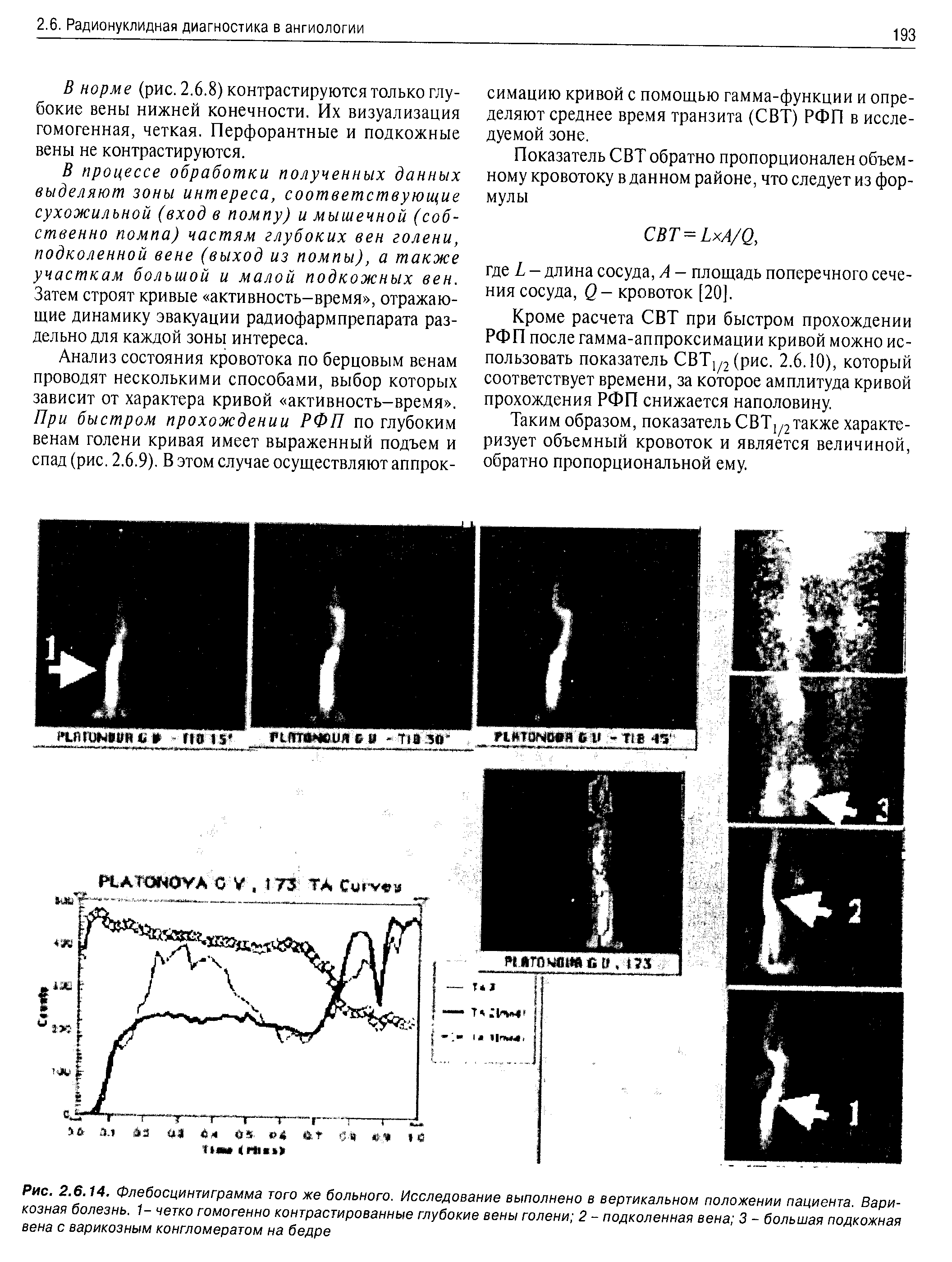 Рис. 2.6.14. Флебосцинтиграмма того же больного. Исследование выполнено в вертикальном положении пациента. Варикозная болезнь. 1- четко гомогенно контрастированные глубокие вены голени 2 - подколенная вена 3 - большая подкожная вена с варикозным конгломератом на бедре...