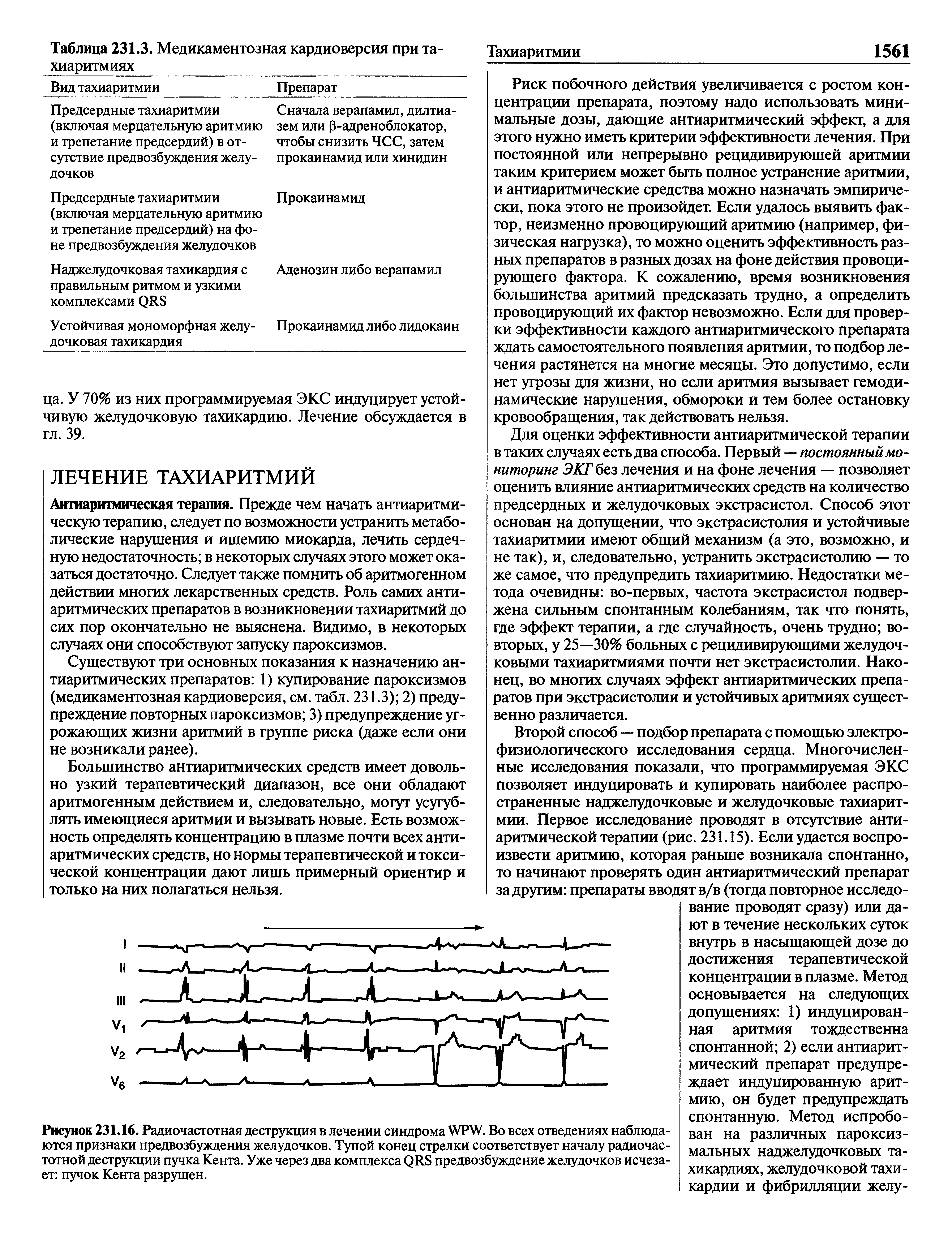 Рисунок 231.16. Радиочастотная деструкция в лечении синдрома WPW. Во всех отведениях наблюдаются признаки предвозбуждения желудочков. Тупой конец стрелки соответствует началу радиочастотной деструкции пучка Кента. Уже через два комплекса предвозбуждение желудочков исчеза-...