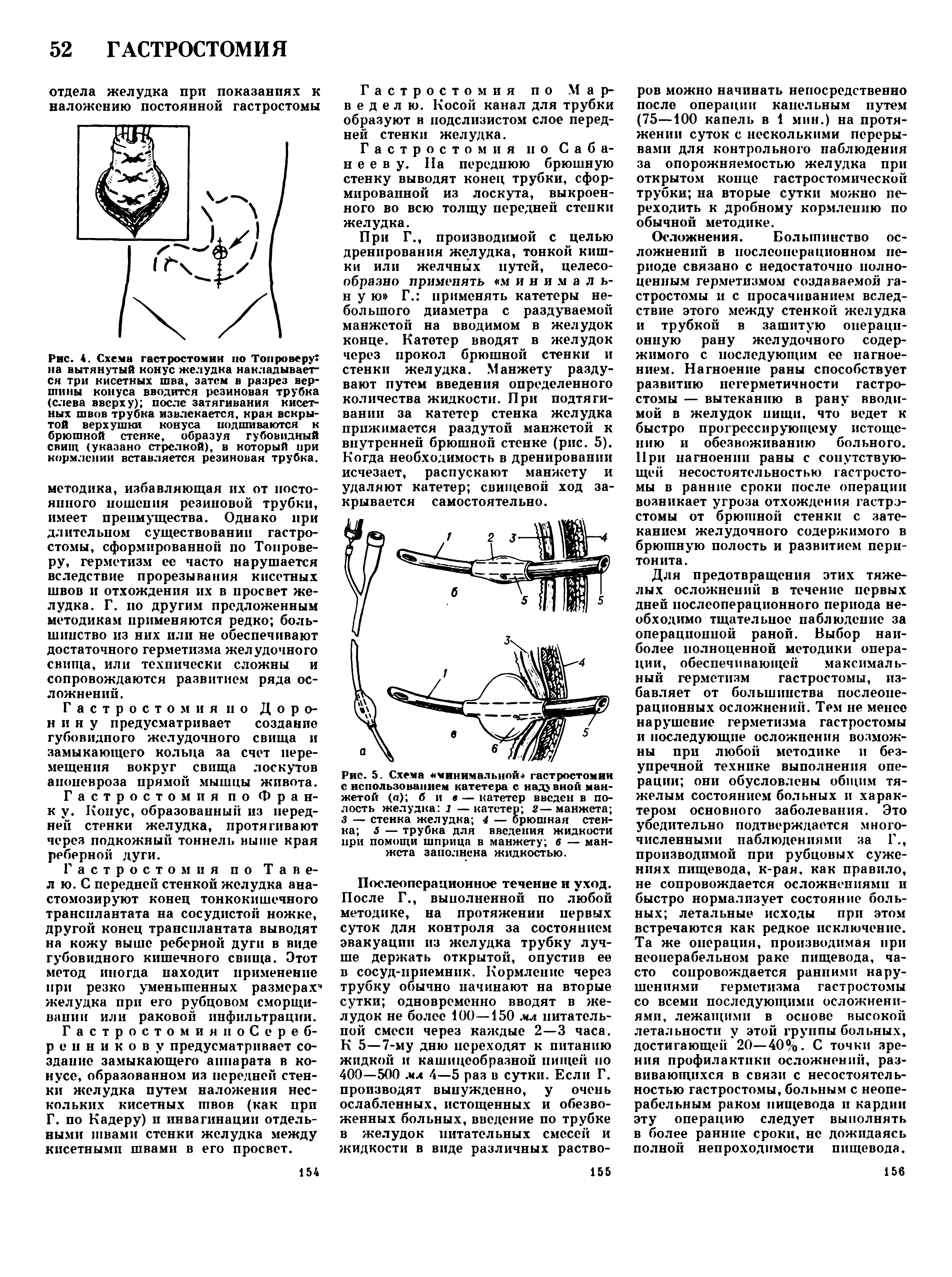 Рис. 5. Схема минимальной- гастростомии с использованием катетера с надувной манжетой (о) б и в — катетер введен в полость желудка 1 — катетер 2— манжета з — стенка желудка 4 — брюшная стенка 5 — трубка для введения жидкости при помощи шприца в манжету 6 — манжета заполнена жидкостью.