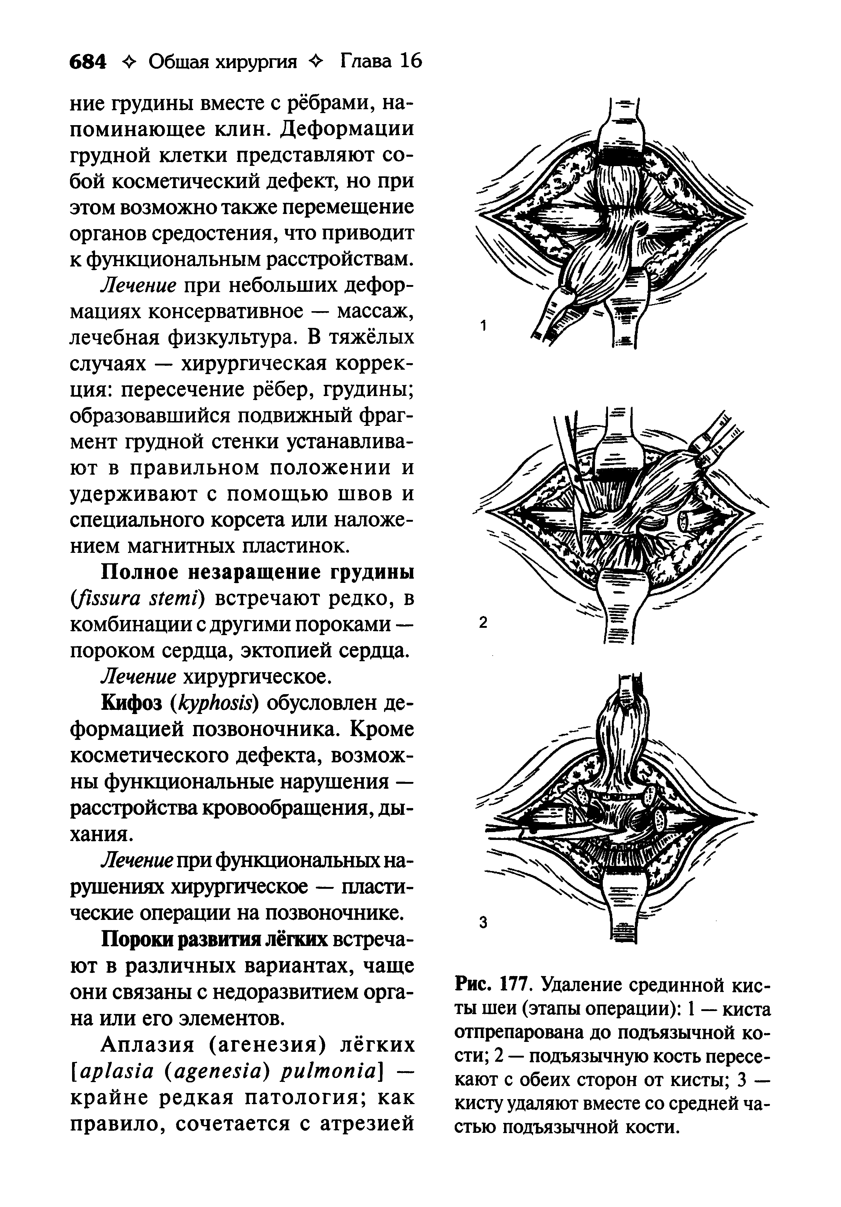 Рис. 177. Удаление срединной кисты шеи (этапы операции) 1 — киста отпрепарована до подъязычной кости 2 — подъязычную кость пересекают с обеих сторон от кисты 3 — кисту удаляют вместе со средней частью подъязычной кости.