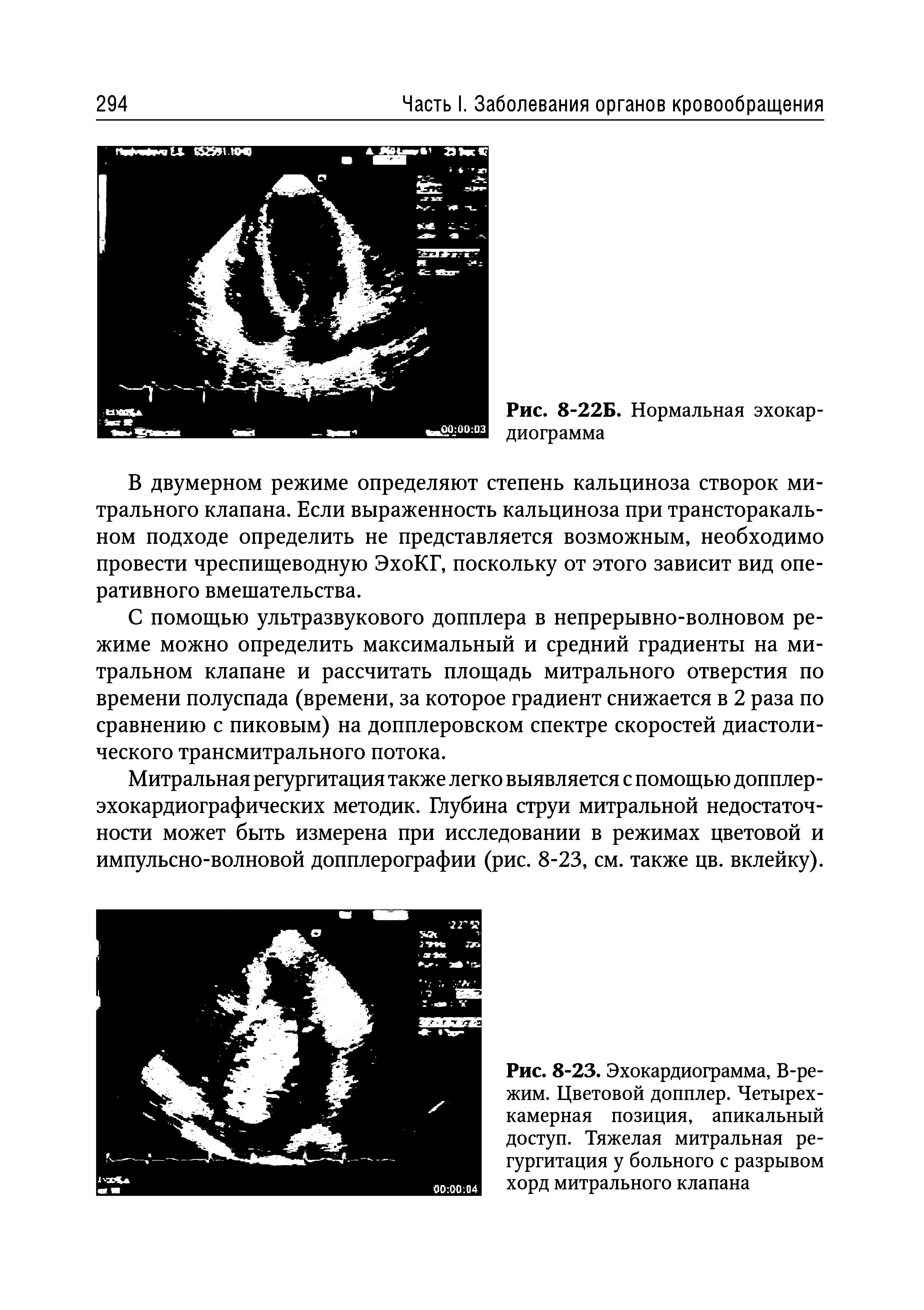 Рис. 8-23. Эхокардиограмма, В-режим. Цветовой допплер. Четырехкамерная позиция, апикальный доступ. Тяжелая митральная регургитация у больного с разрывом хорд митрального клапана...