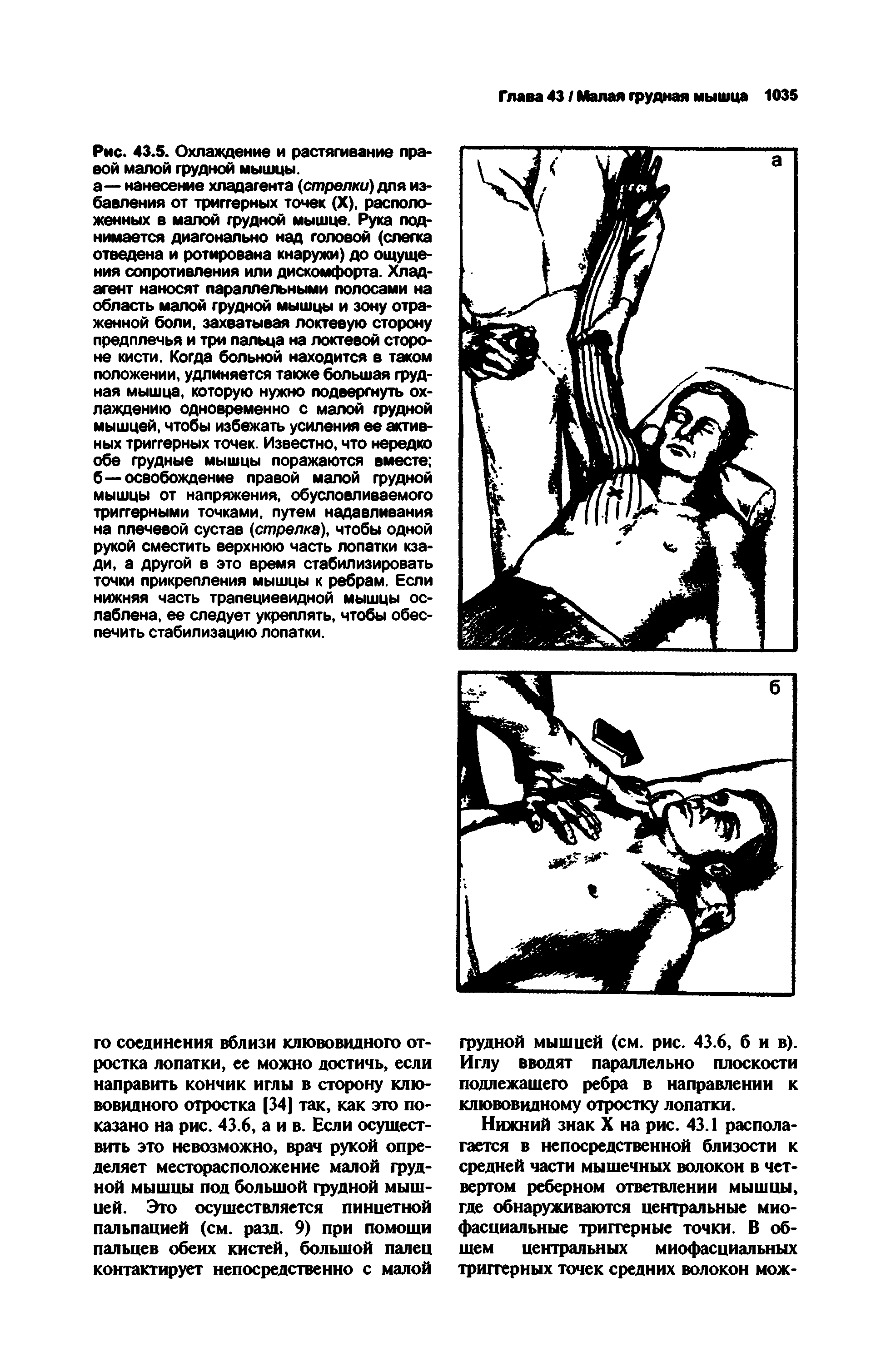 Рис. 43.5. Охлаждение и растягивание правой малой грудной мышцы.