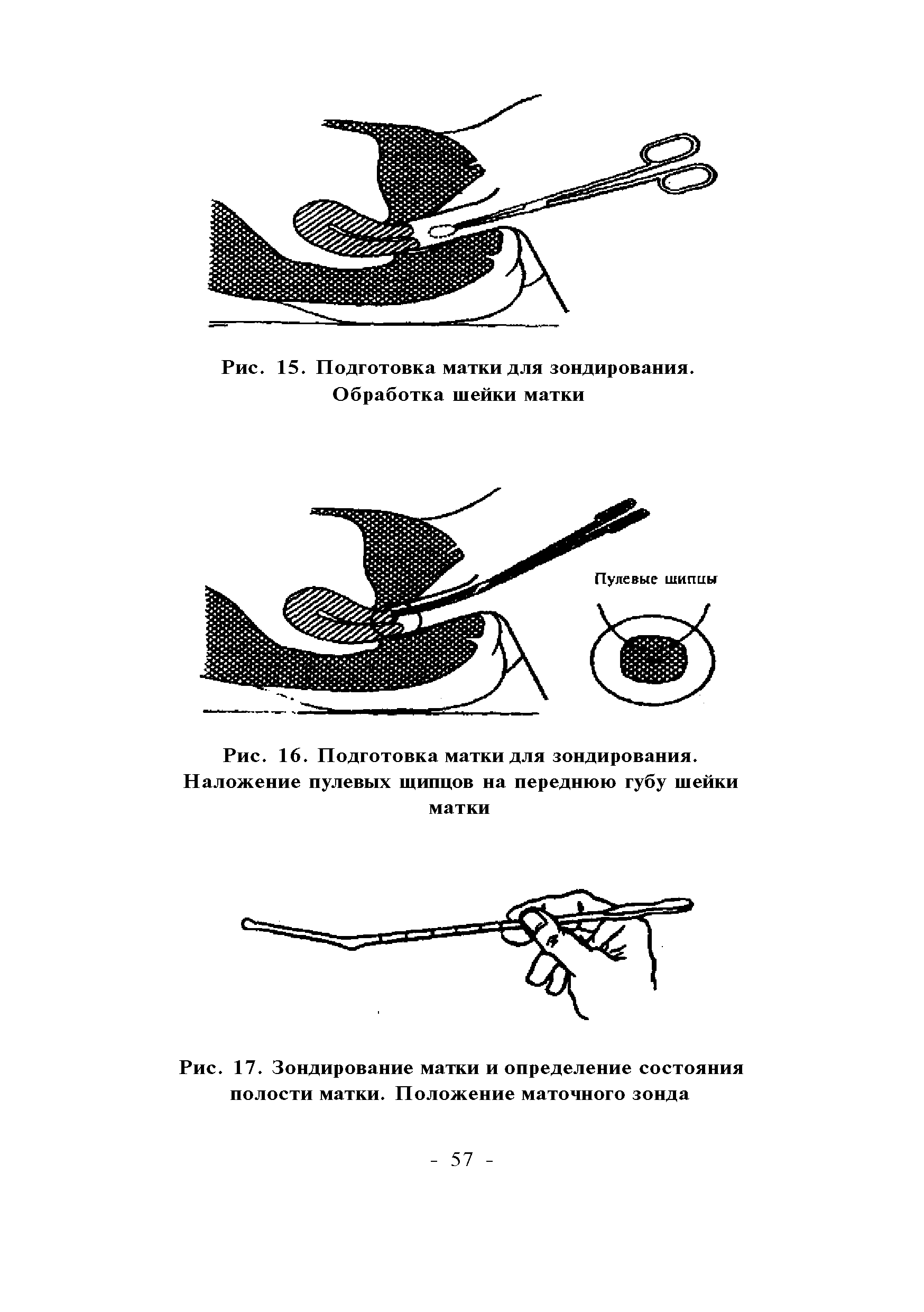 Рис. 17. Зондирование матки и определение состояния полости матки. Положение маточного зонда...