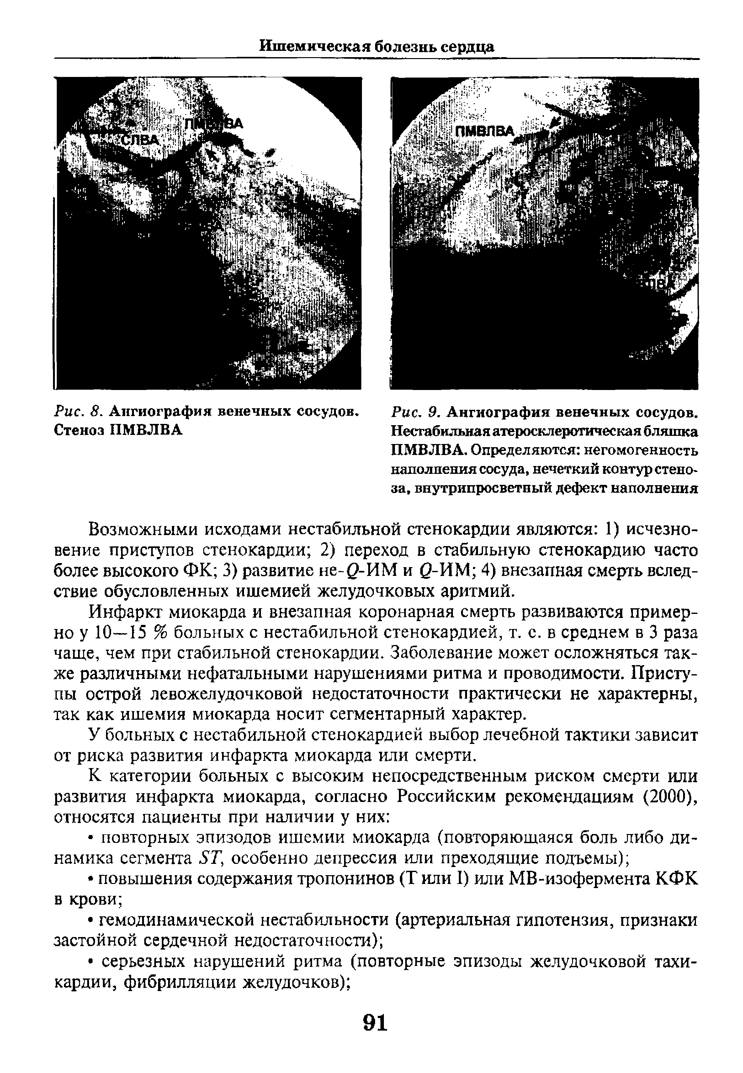 Рис. 9. Ангиография венечных сосудов. Нестабильная атеросклеротическая бляшка ПМВЛВА. Определяются негомогенность наполнения сосуда, нечеткий контур стеноза, внутрипросветный дефект наполнения...