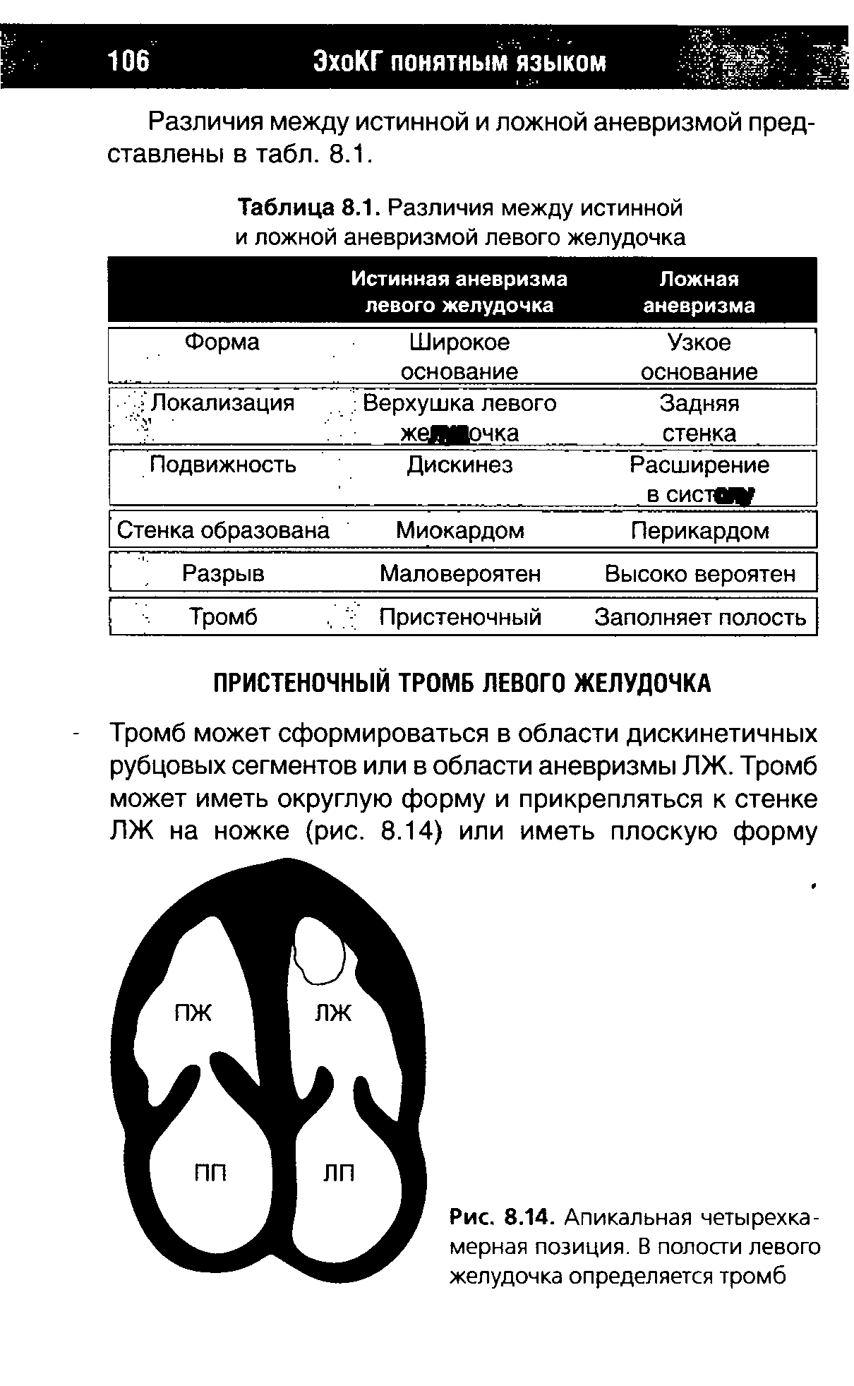 Таблица 8.1. Различия между истинной и ложной аневризмой левого желудочка...