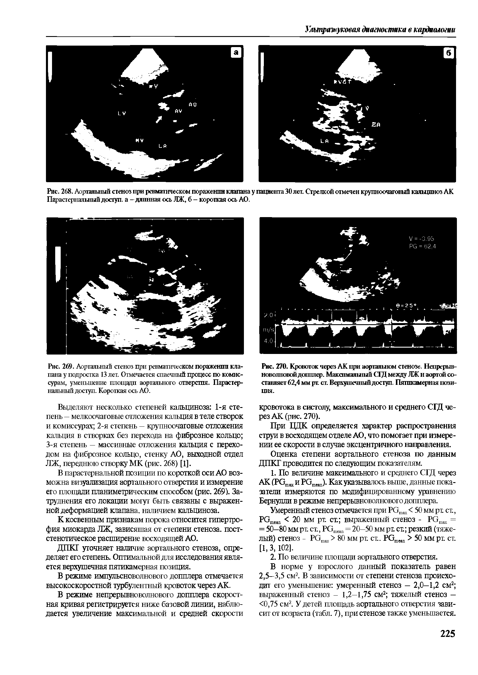 Рис. 270. Кровоток через АК при аортальном стенозе. Непрерывноволновой допплер. Максимальный С1Д между ЛЖ и аортой составляет 62,4 мм рт. ст. Верхушечный доступ. Пятпкамерная пози-...