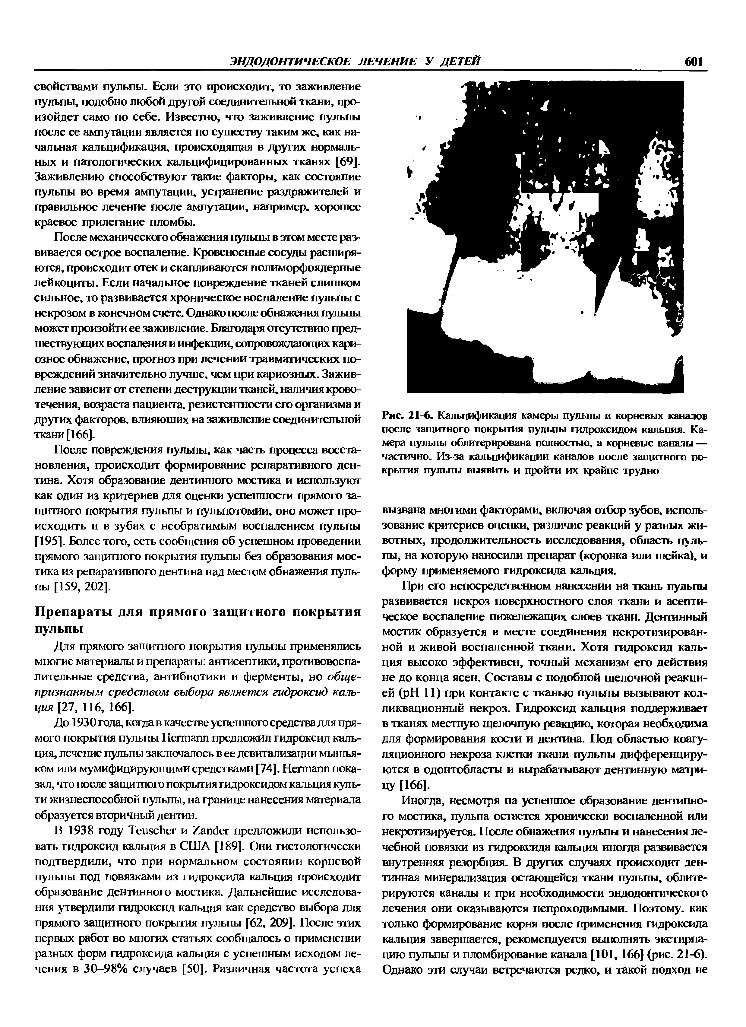 Рис. 21-6. Кальцификация камеры пульпы и корневых каналов после защитного покрытия пульпы гидроксидом кальция. Камера пульпы облитерирована полностью, а корневые каналы — частично. Из-за кальцификации каналов после защитного покрытия пульпы выявить и пройти их крайне трудно...