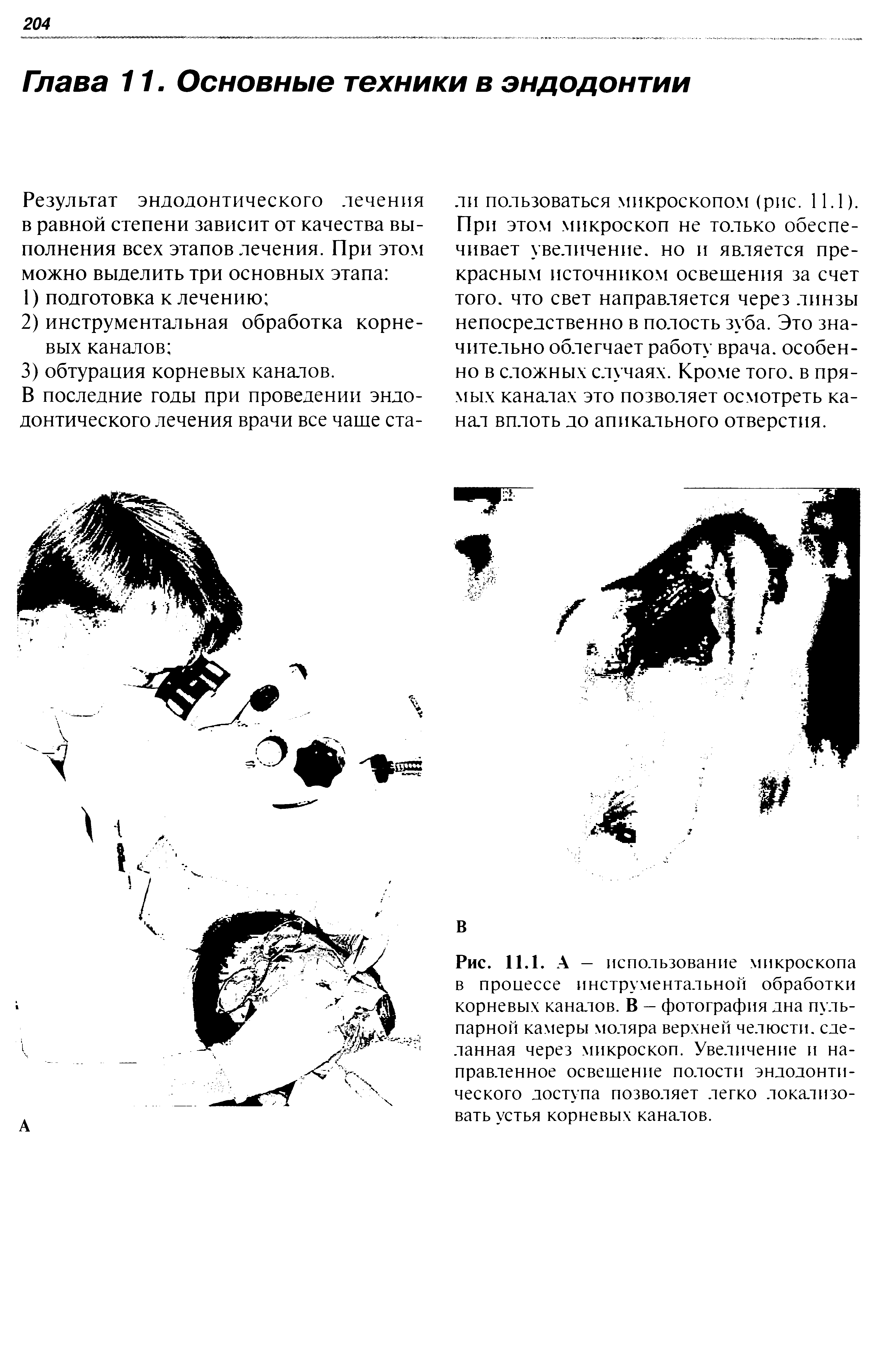 Рис. 11.1. А — использование микроскопа в процессе инструментальной обработки корневых каналов. В — фотография дна пульпарной камеры моляра верхней челюсти, сделанная через микроскоп. Увеличение и направленное освещение полости эндодонтического доступа позволяет легко локализовать устья корневых каналов.