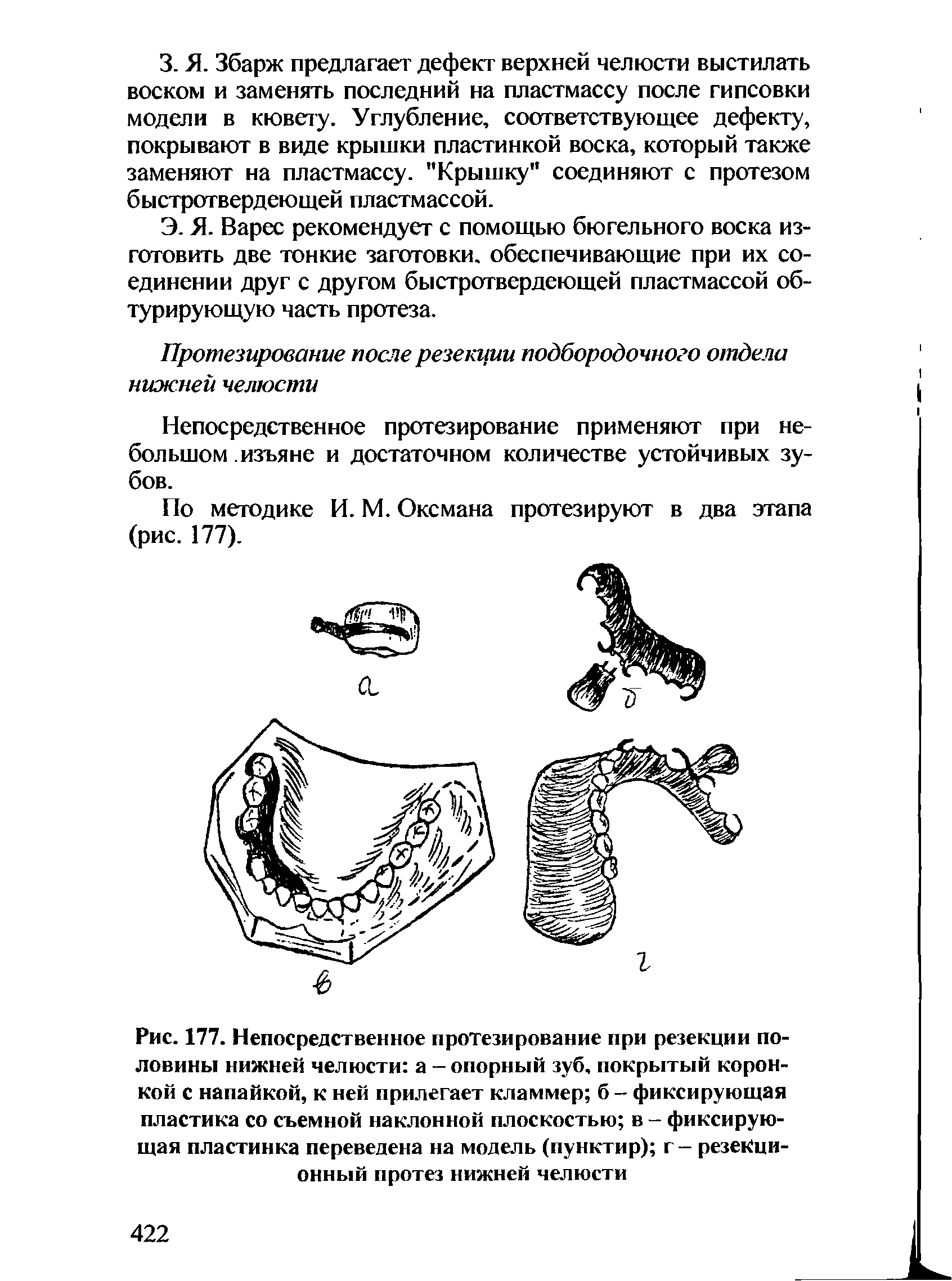 Рис. 177. Непосредственное протезирование при резекции половины нижней челюсти а - опорный зуб, покрытый коронкой с напайкой, к ней прилегает кламмер б - фиксирующая пластика со съемной наклонной плоскостью в - фиксирующая пластинка переведена на модель (пунктир) г - резекционный протез нижней челюсти...