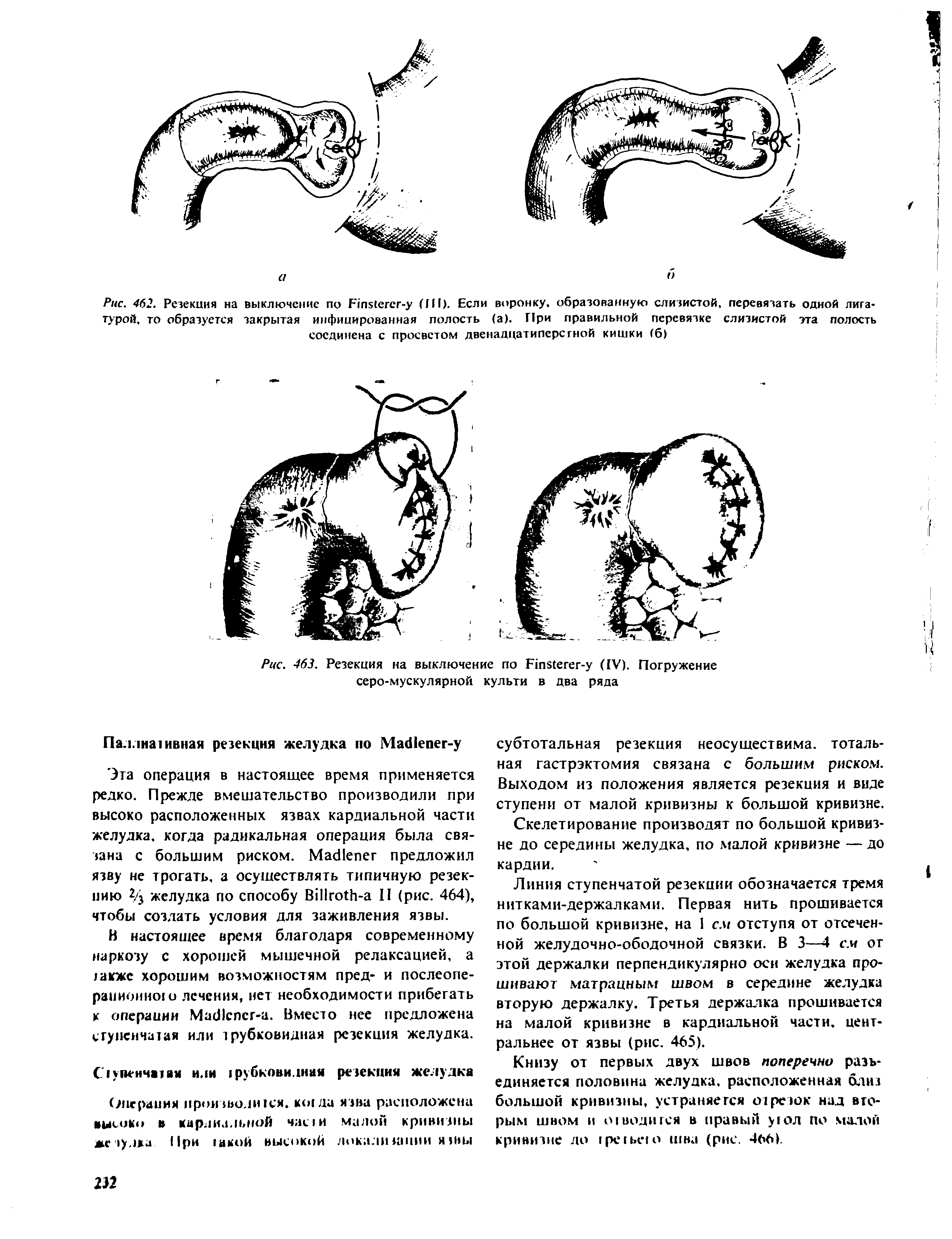 Рис. 463. Резекция на выключение по Р1п8Сегег-у (IV). Погружение серо-мускулярной культи в два ряда...