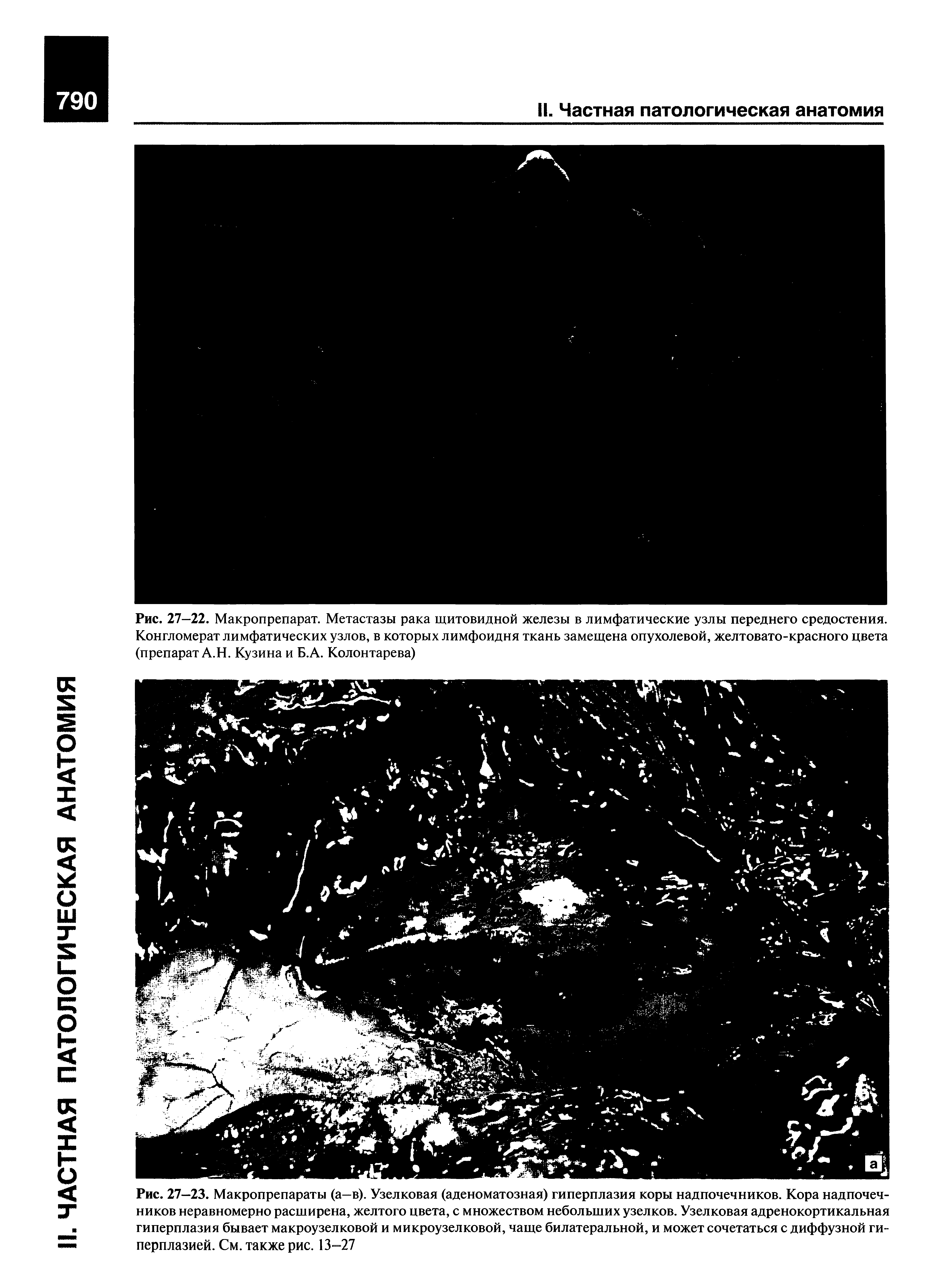 Рис. 27—23. Макропрепараты (а—в). Узелковая (аденоматозная) гиперплазия коры надпочечников. Кора надпочечников неравномерно расширена, желтого цвета, с множеством небольших узелков. Узелковая адренокортикальная гиперплазия бывает макроузелковой и микроузелковой, чаще билатеральной, и может сочетаться с диффузной гиперплазией. См. также рис. 13=27...