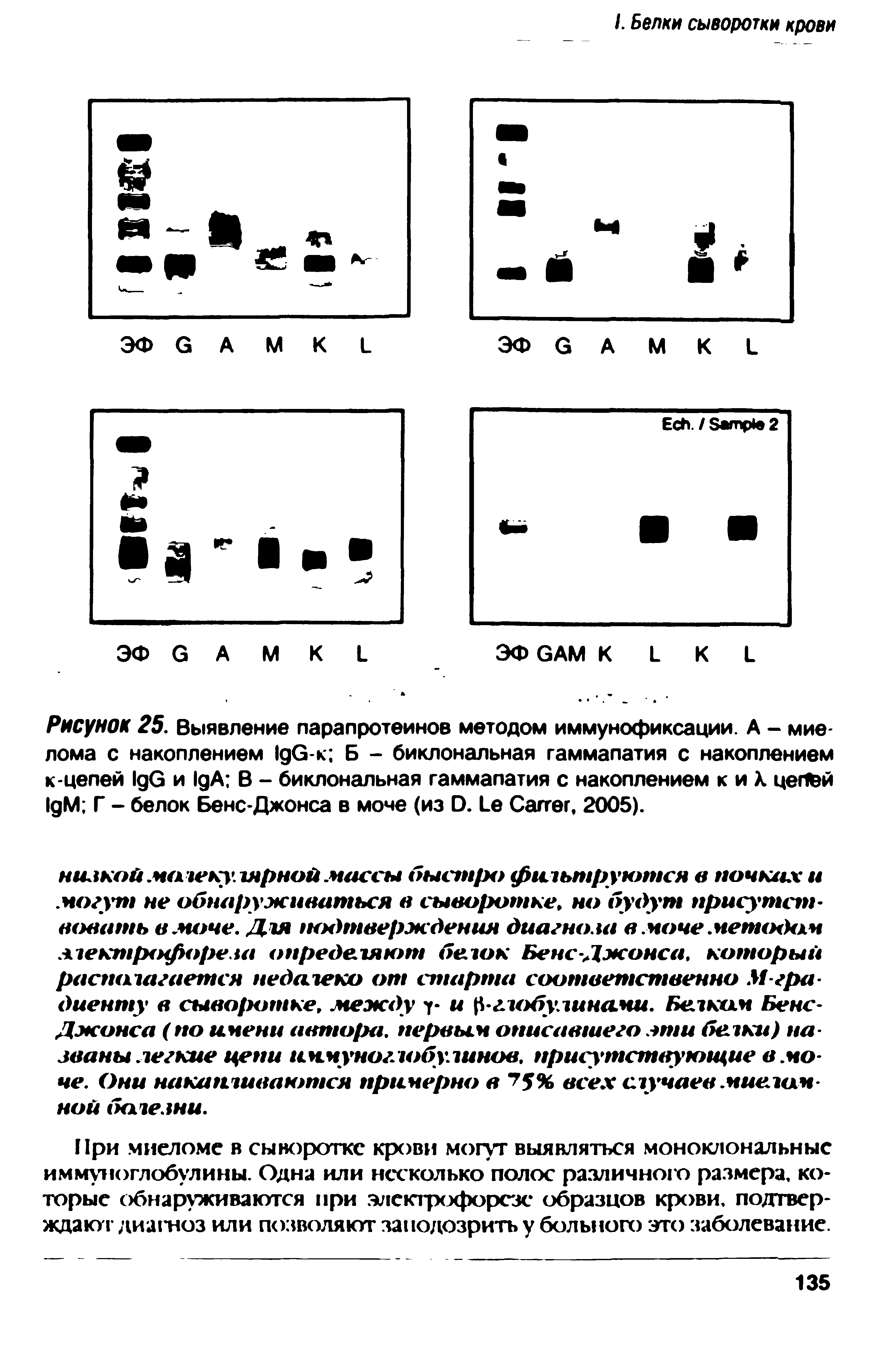 Рисунок 25. Выявление парапротеинов методом иммунофиксации. А - миелома с накоплением I G-к Б - биклональная гаммапатия с накоплением к-целей I G и I A В - биклональная гаммапатия с накоплением к и К цепей I M Г - белок Бенс-Джонса в моче (из D. L C , 2005).