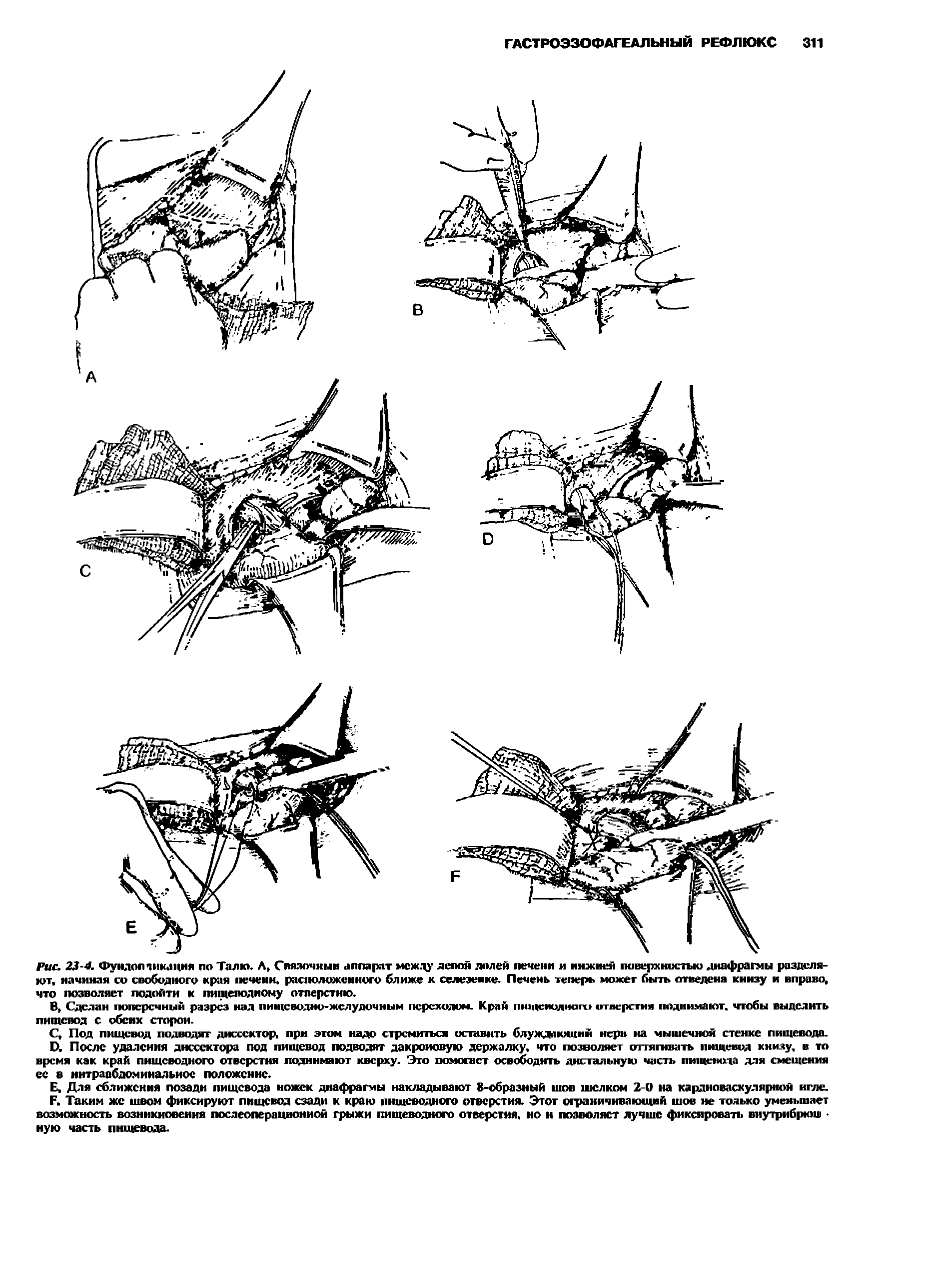 Рис. 23-4. Фундопликация по Талю. Л Связочный аппарат между левой долей печени и нижней поверхностью диафрагмы разделяют, начиная со свободного края печени. расположенного ближе к селезенке. Печень теперь может быть отведена книзу и вправо, что позволяет подойти к пищеподному отверстию.