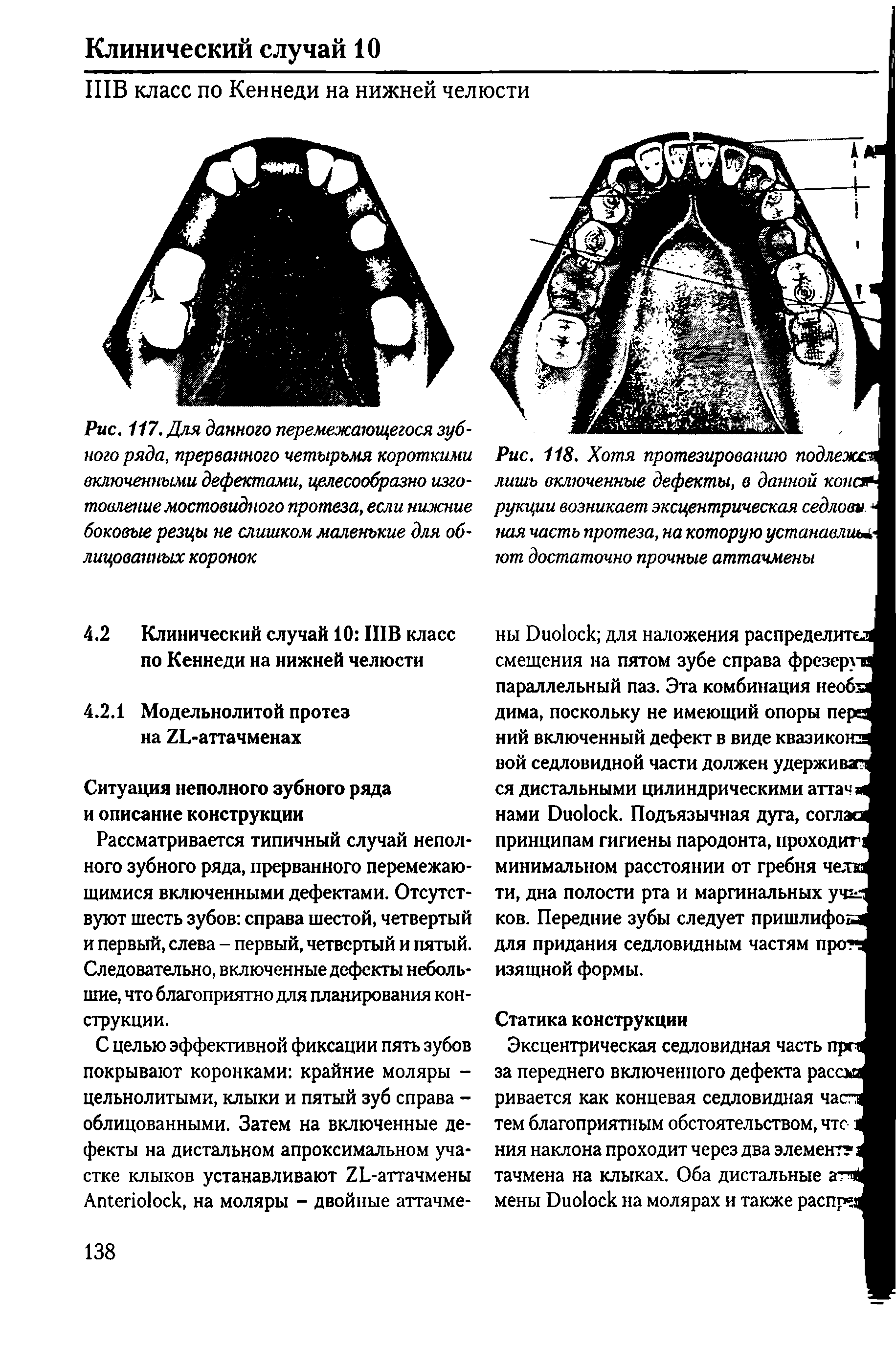 Рис. 117. Для данного перемежающегося зубного ряда, прерванного четырьмя короткими включенными дефектами, целесообразно изготовление мостовидного протеза, если нижние боковые резцы не слишком маленькие для об-...