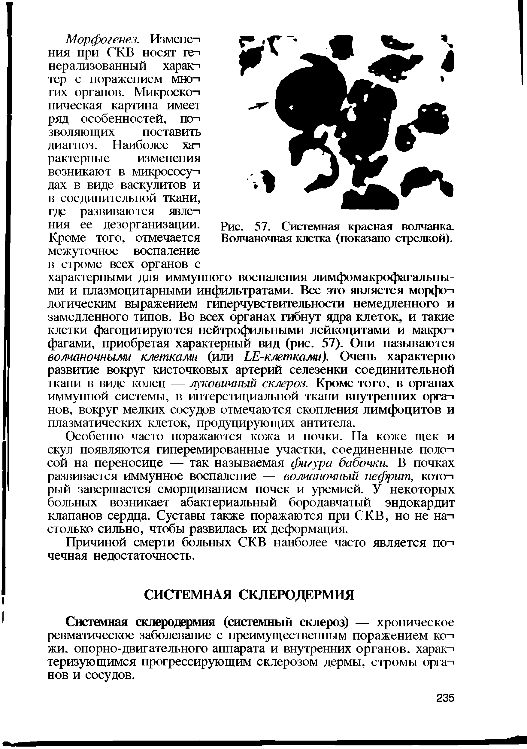 Рис. 57. Системная красная волчанка. Волчаночная клетка (показано стрелкой).