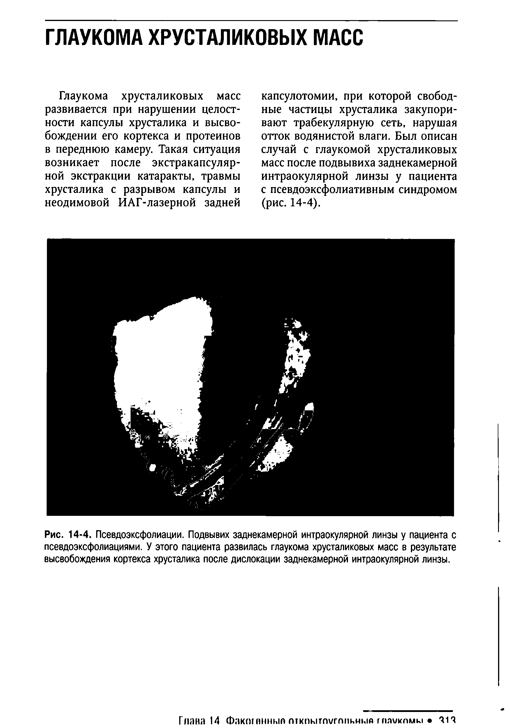 Рис. 14-4. Псевдоэксфолиации. Подвывих заднекамерной интраокулярной линзы у пациента с псевдоэксфолиациями. У этого пациента развилась глаукома хрусталиковых масс в результате высвобождения кортекса хрусталика после дислокации заднекамерной интраокулярной линзы.