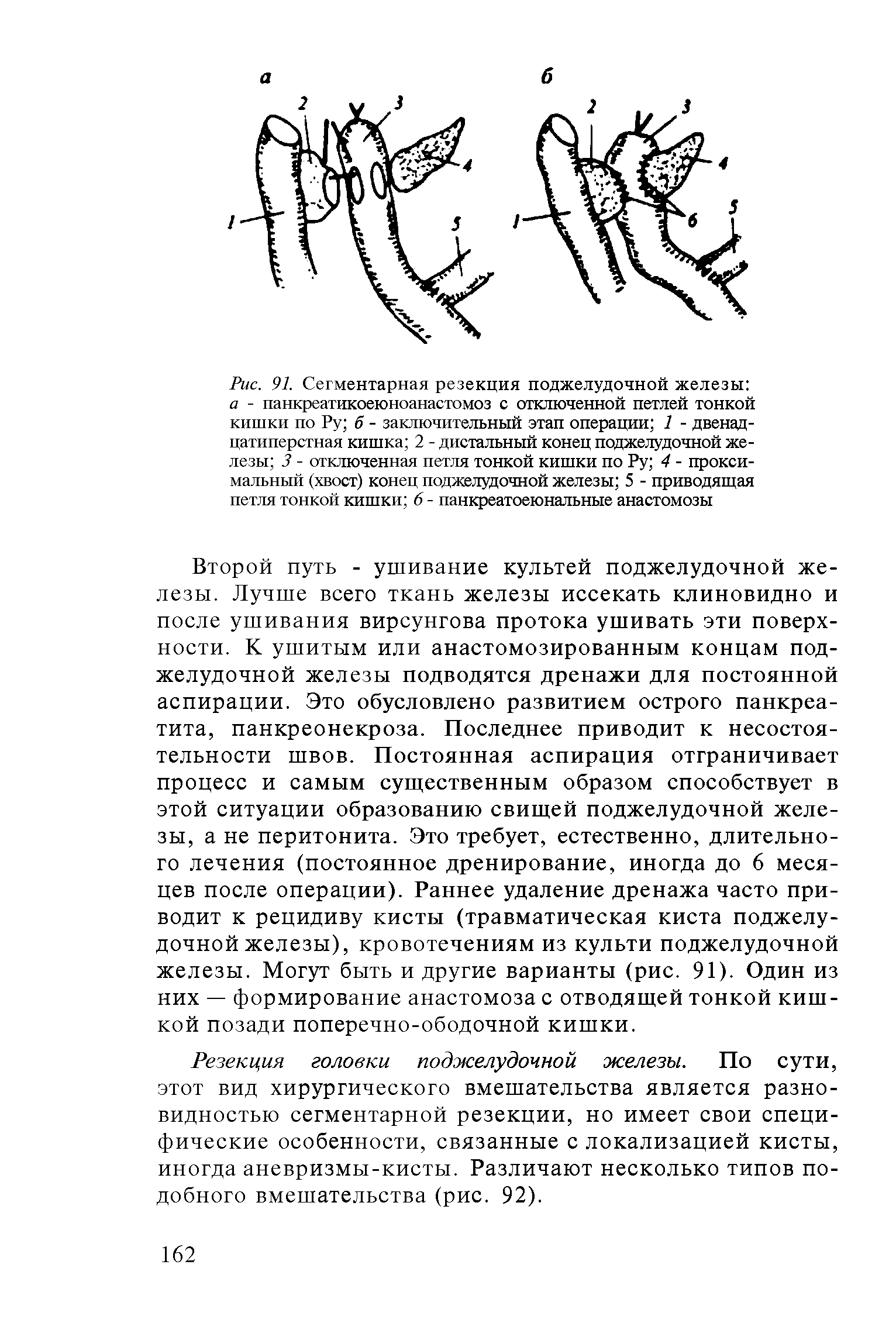 Рис. 91. Сегментарная резекция поджелудочной железы а - панкреатикоеюноанастомоз с отключенной петлей тонкой кишки по Ру б - заключительный этап операции 1 - двенадцатиперстная кишка 2 - дистальный конец поджелудочной железы 3 - отключенная петля тонкой кишки по Ру 4 - проксимальный (хвост) конец поджелудочной железы 5 - приводящая петля тонкой кишки 6 - панкреатоеюнальные анастомозы...