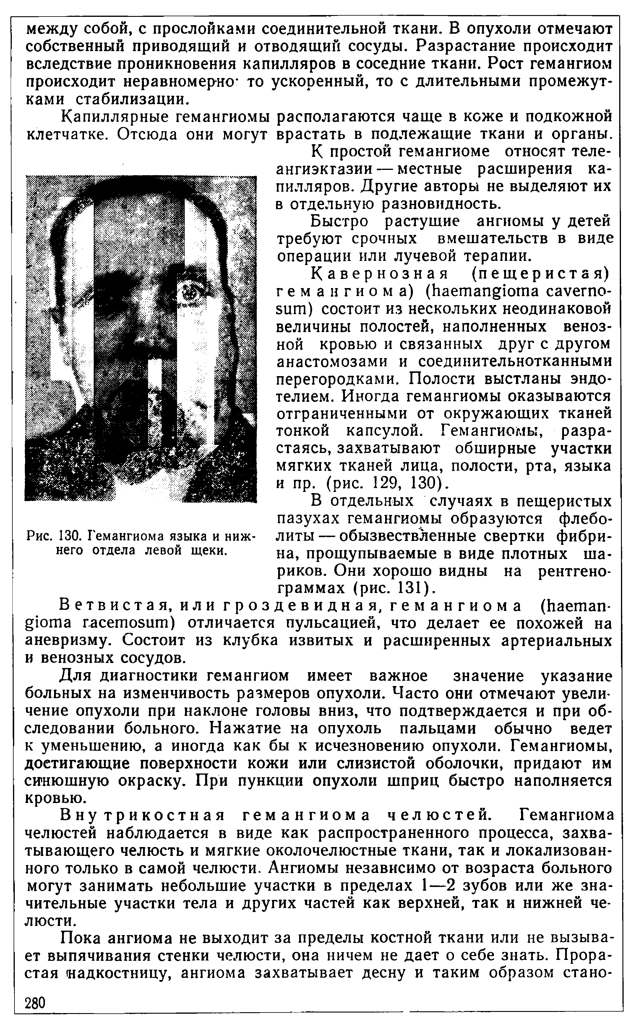 Рис. 130. Гемангиома языка и нижнего отдела левой щеки.