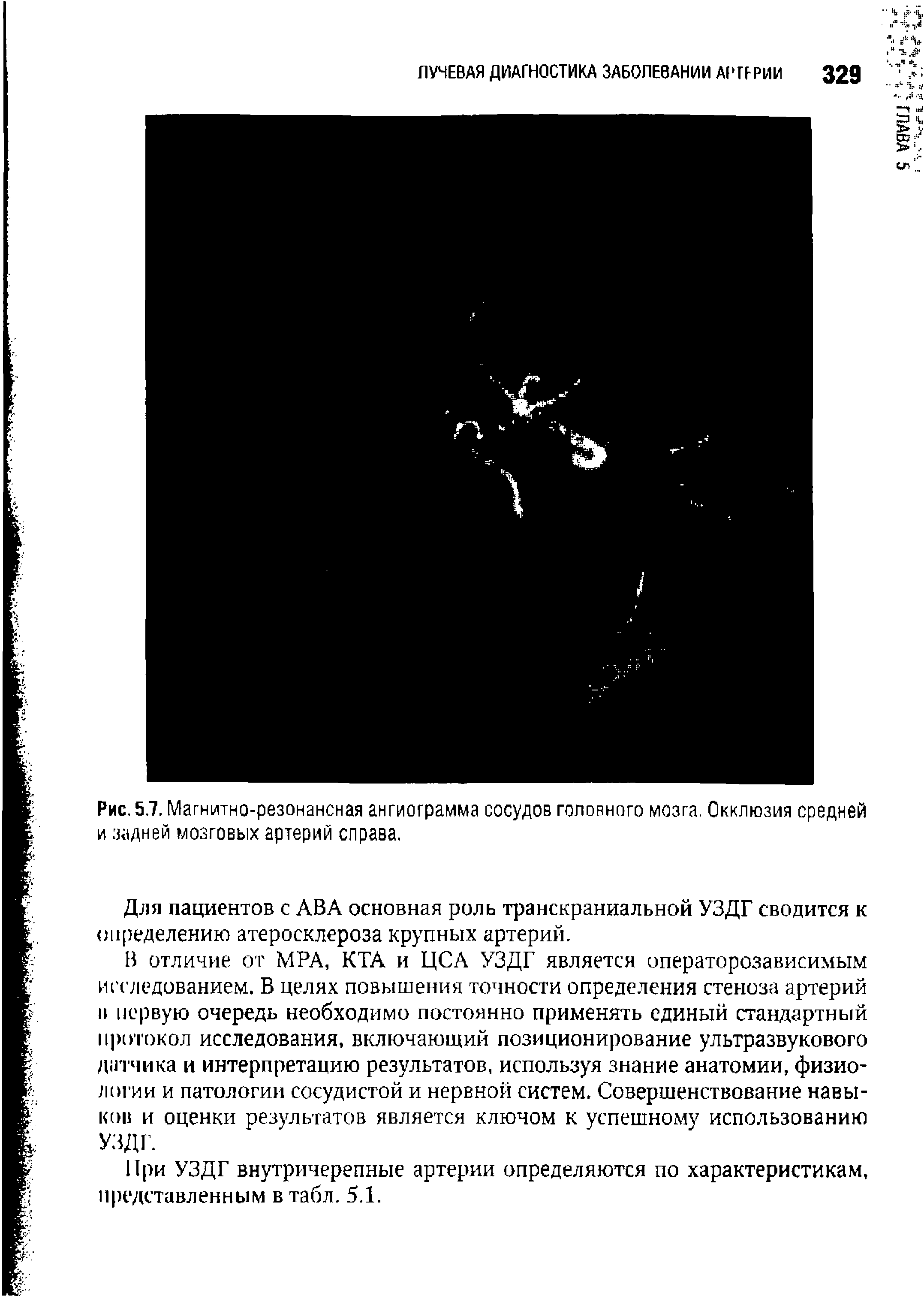 Рис. 5.7. Магнитно-резонансная ангиограмма сосудов головного мозга. Окклюзия средней и задней мозговых артерий справа.