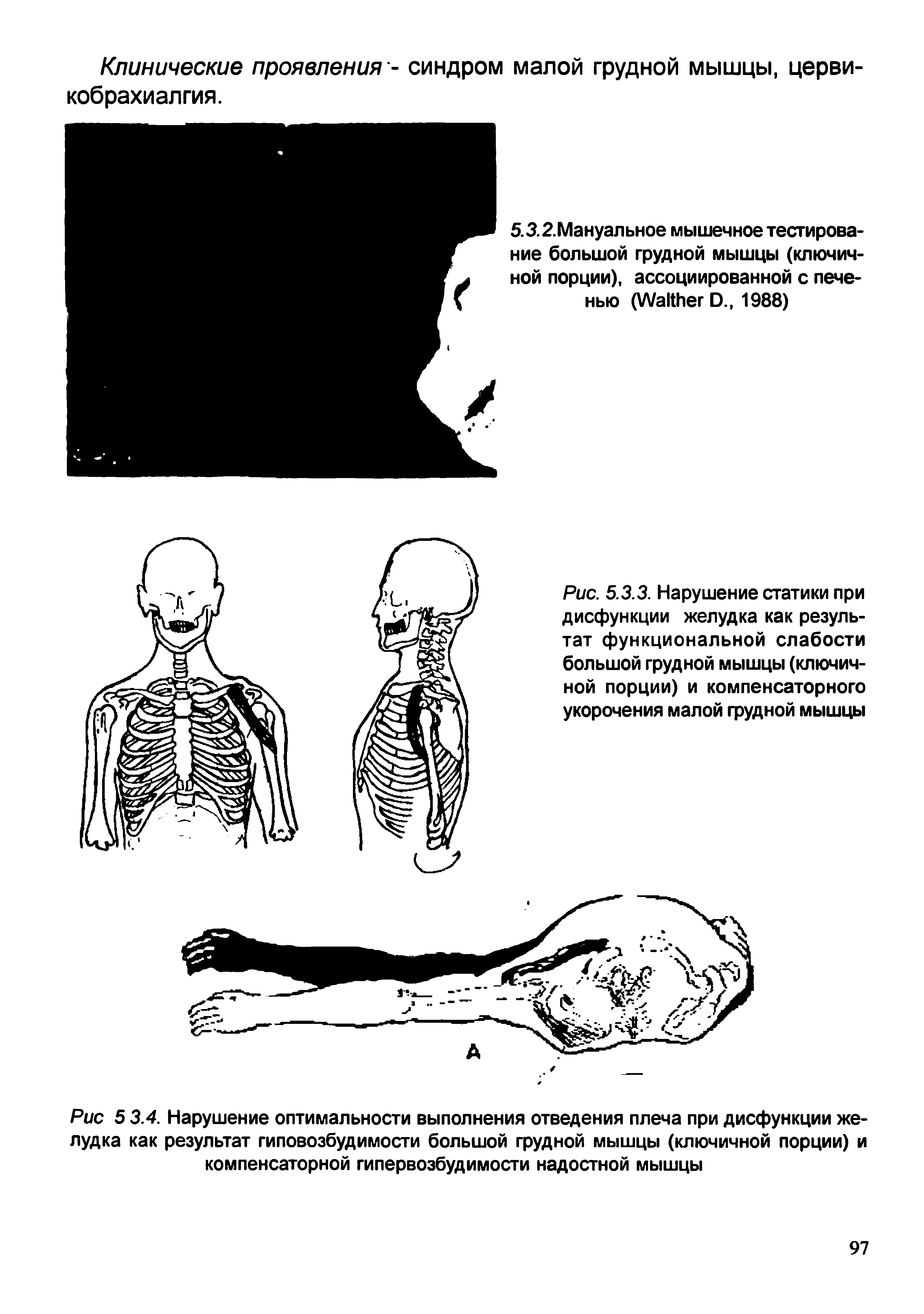 Рис. 5.3.3. Нарушение статики при дисфункции желудка как результат функциональной слабости большой грудной мышцы (ключичной порции) и компенсаторного укорочения малой грудной мышцы...