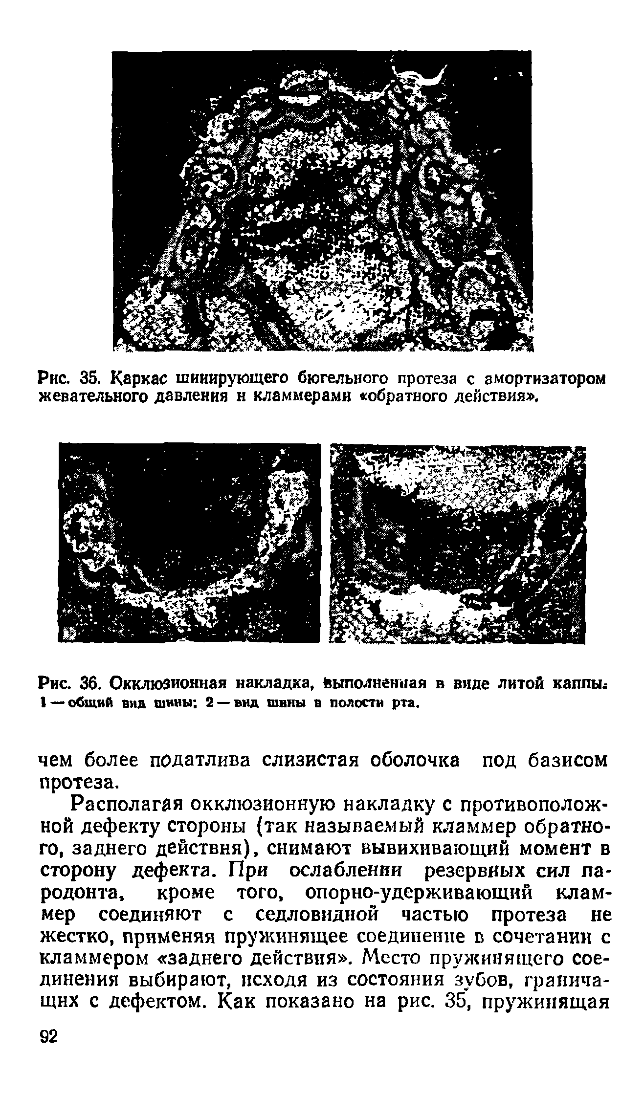 Рис. 36. Окклюзионная накладка, Выполненная в виде литой каппы.-I — общий вид шины 2 — вид шины в полости рта.