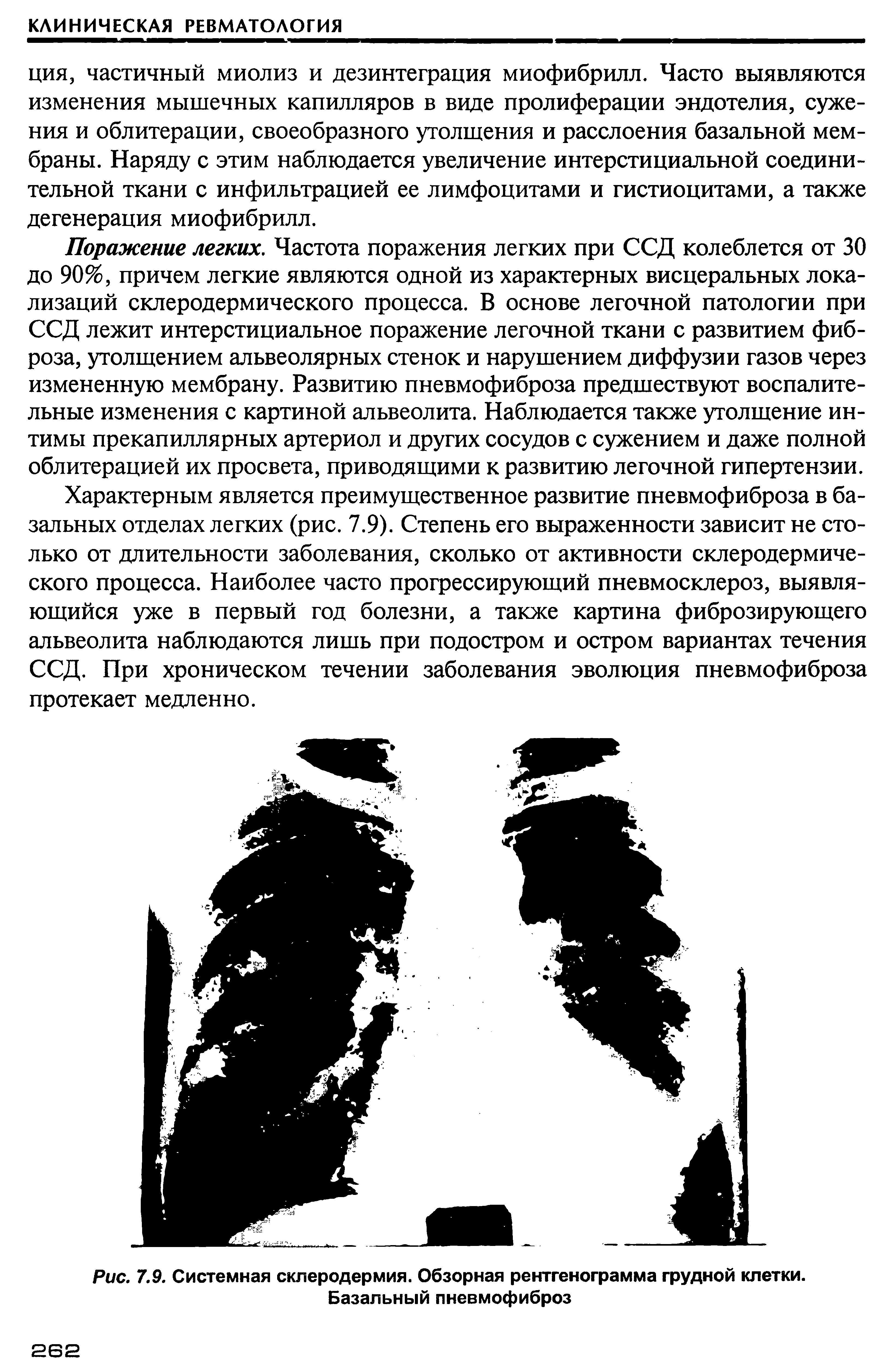 Рис. 7.9. Системная склеродермия. Обзорная рентгенограмма грудной клетки. Базальный пневмофиброз...