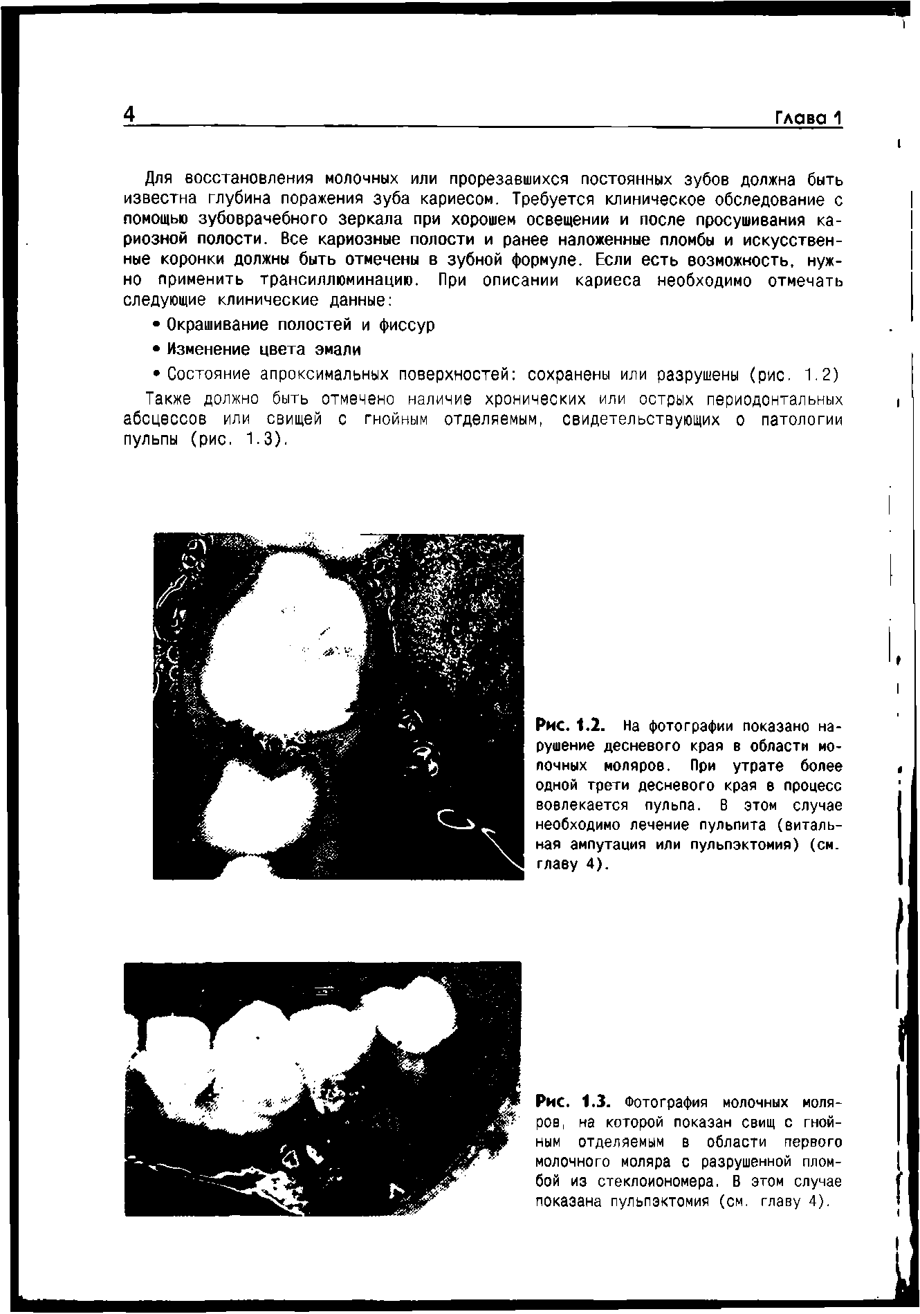 Рис. 1.2. На фотографии показано нарушение десневого края в области молочных моляров. При утрате более одной трети десневого края в процесс вовлекается пульпа. В этом случае необходимо лечение пульпита (витальная ампутация или пульпэктомия) (см. главу 4).