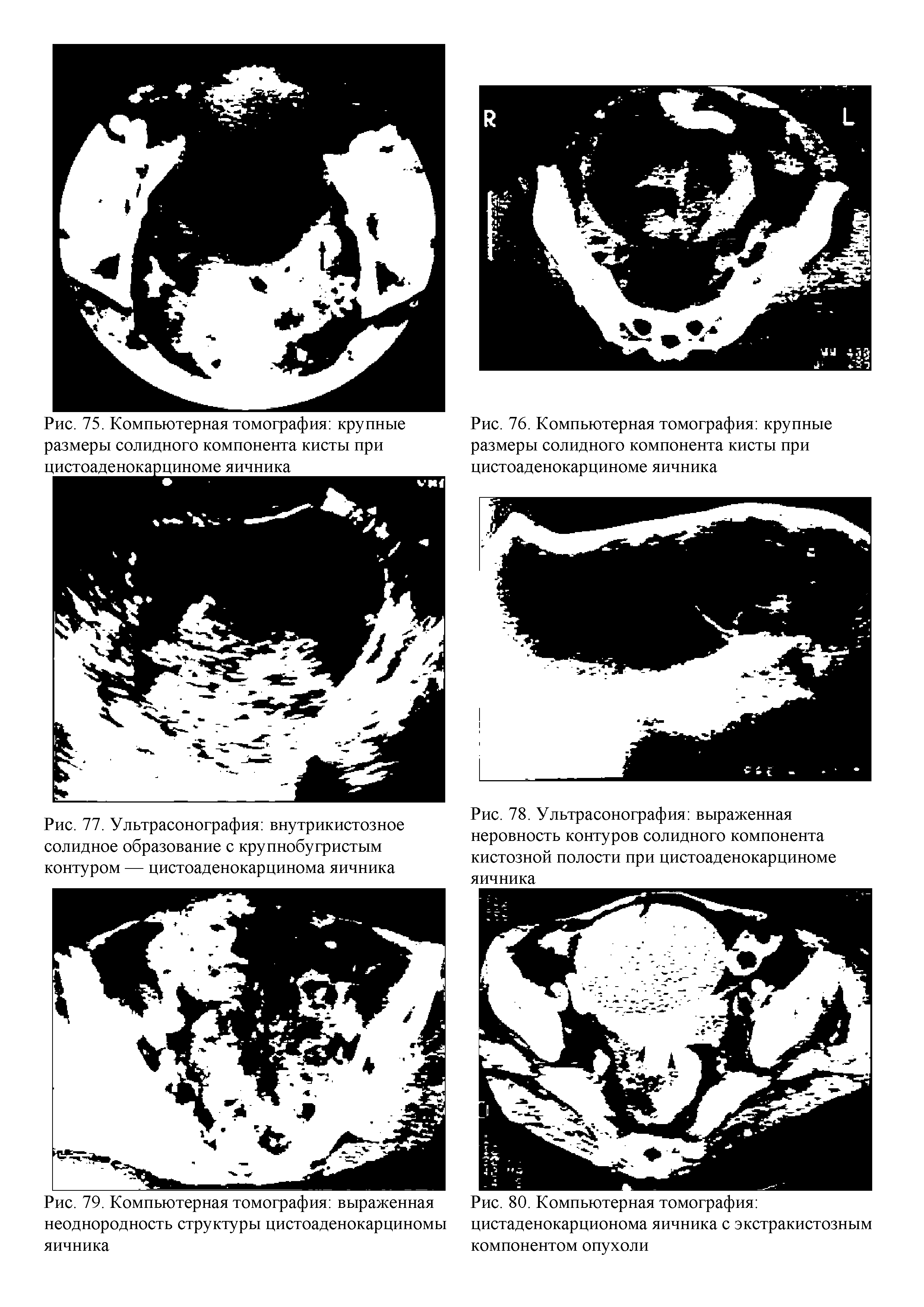 Рис. 77. Ультрасонография внутрикистозное солидное образование с крупнобугристым контуром — цистоаденокарцинома яичника...