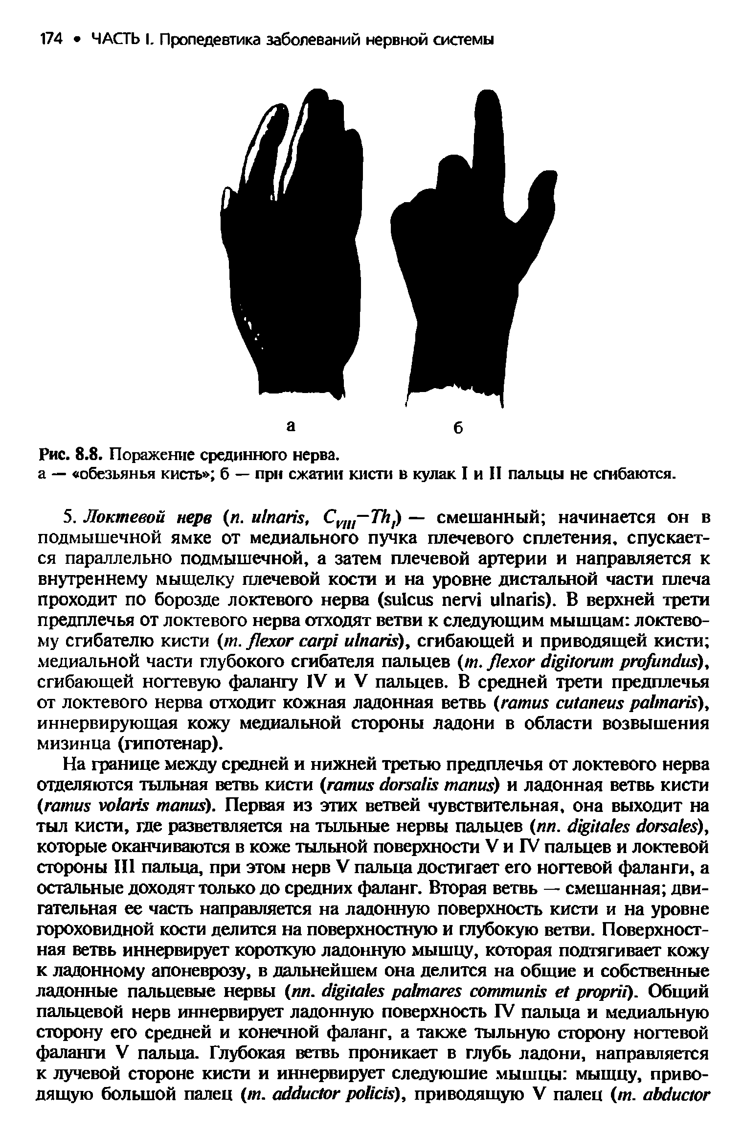 Рис. 8.8. Поражение срединного нерва, а — обезьянья кисть б — при сжатии кисти в кулак I и II пальцы не сгибаются.