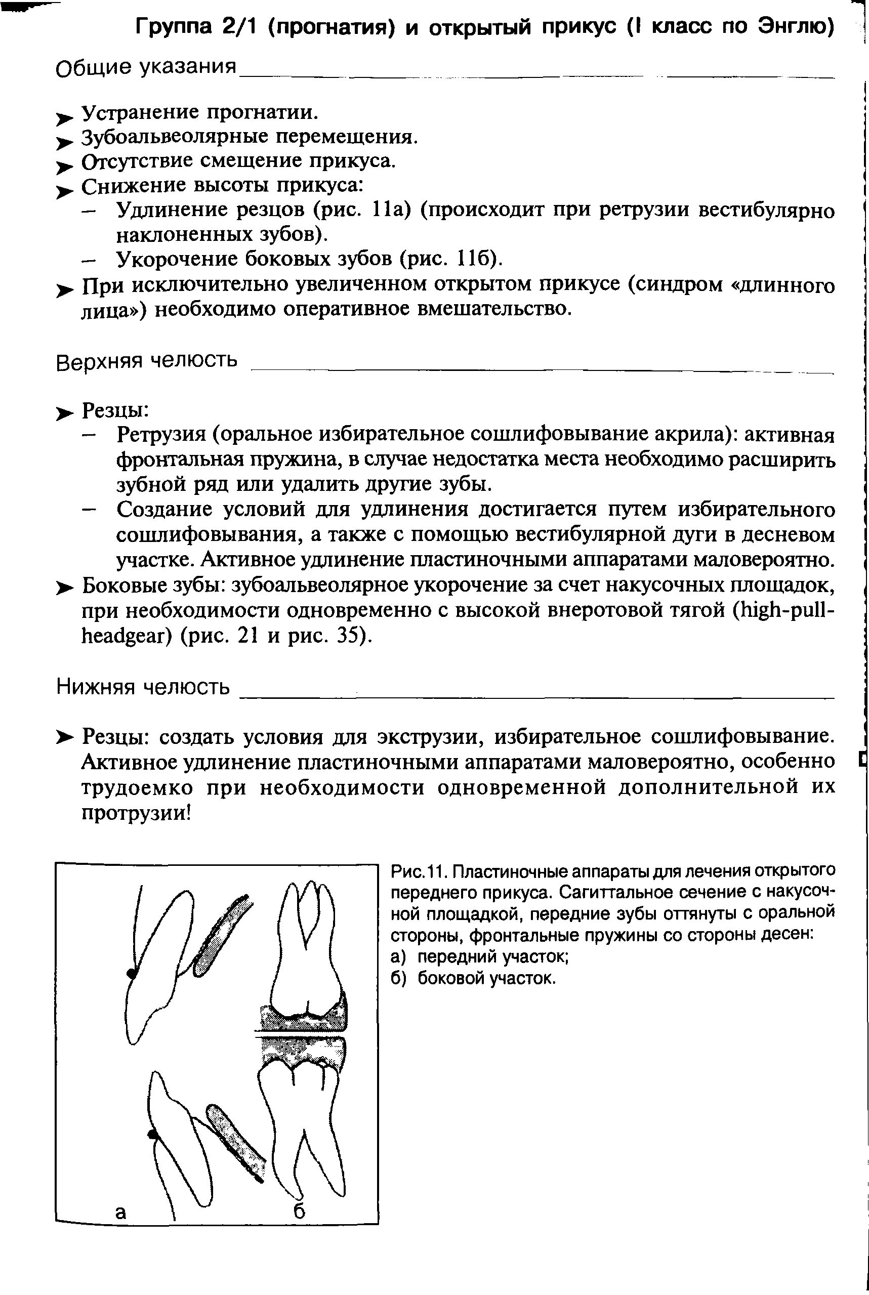 Рис.11. Пластиночные аппараты для лечения открытого переднего прикуса. Сагиттальное сечение с накусоч-ной площадкой, передние зубы оттянуты с оральной стороны, фронтальные пружины со стороны десен ...