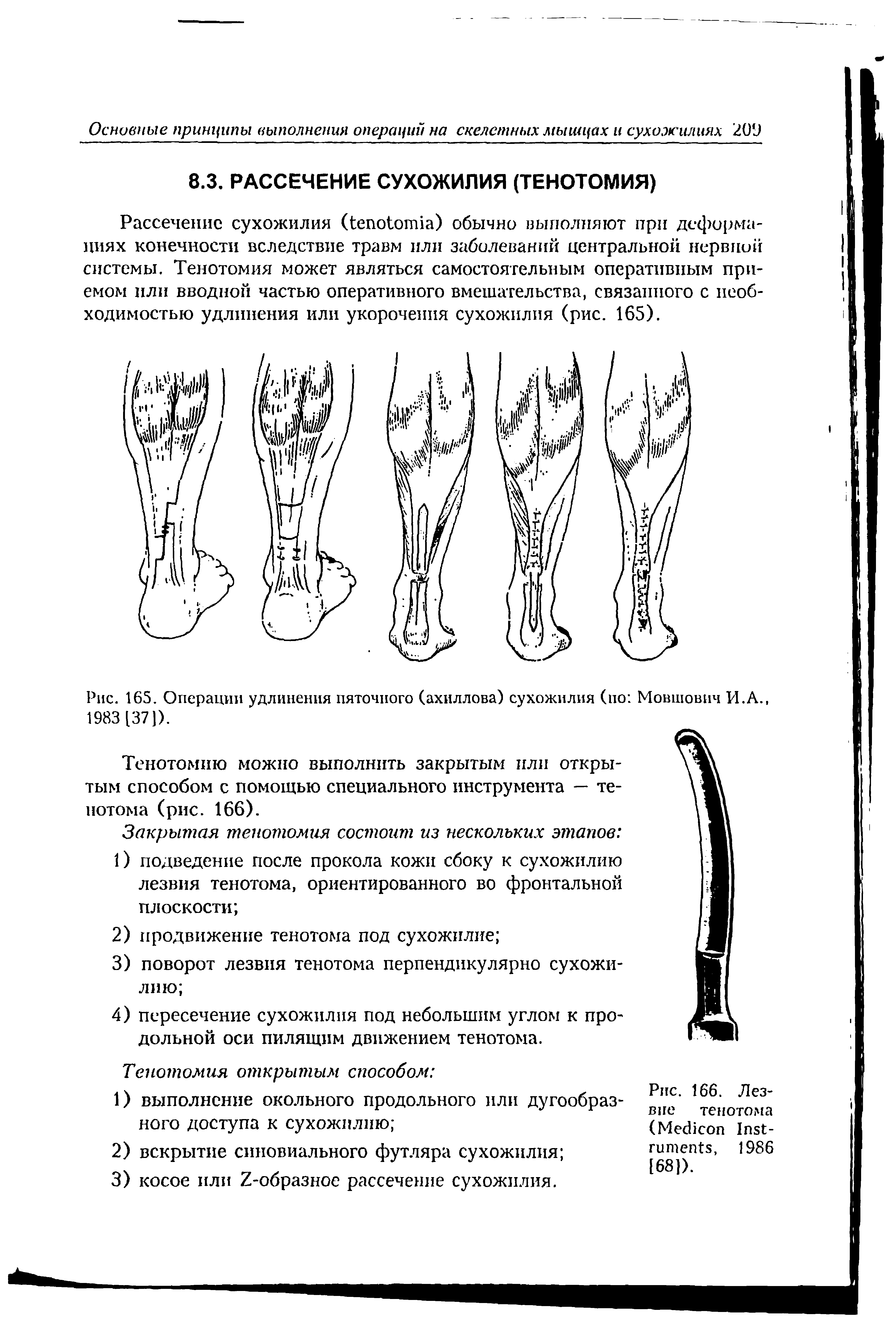 Рис. 165. Операции удлинения пяточного (ахиллова) сухожилия (по Мовшович И.А.,...