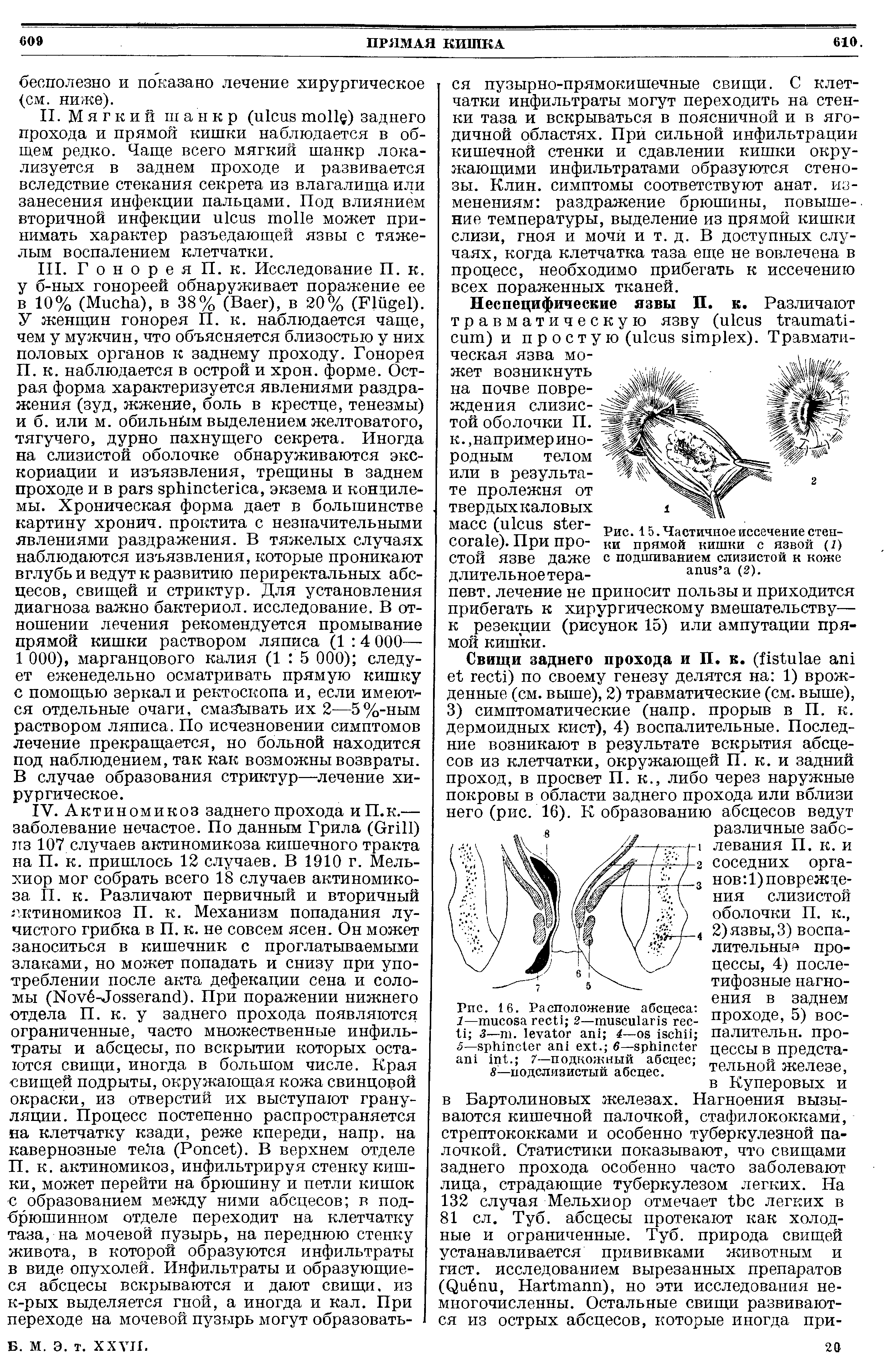 Рис. 15. Частичное иссечение стенки прямой кишки с язвой (1) с подшиванием слизистой к коже апив а (2).