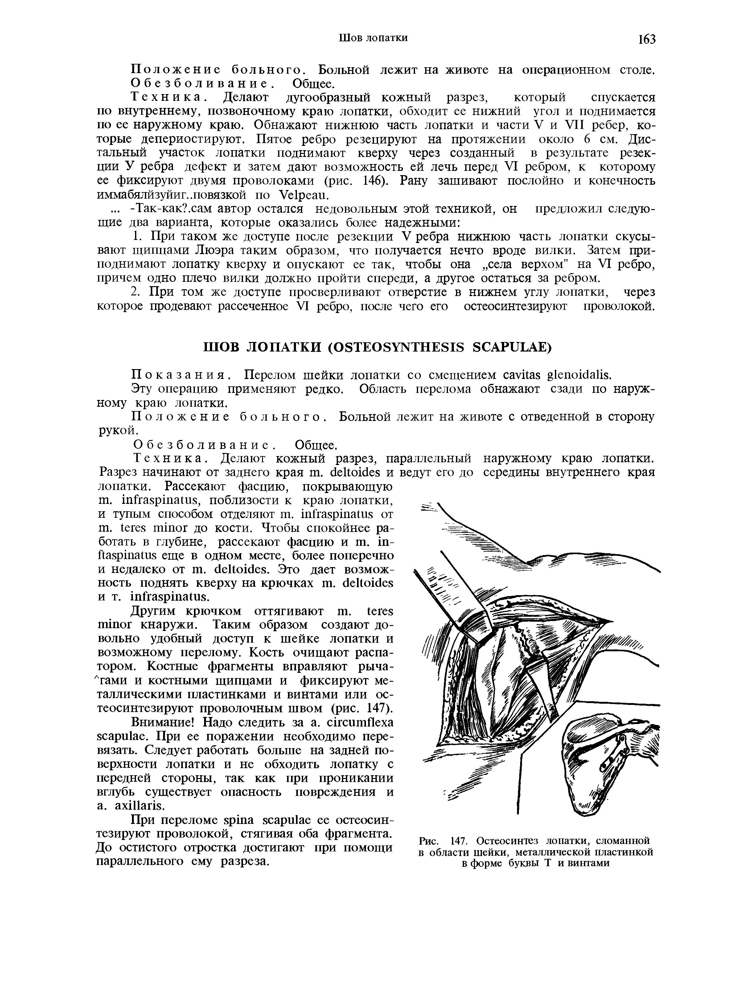 Рис. 147. Остеосинтез лопатки, сломанной в области шейки, металлической пластинкой в форме буквы Т и винтами...