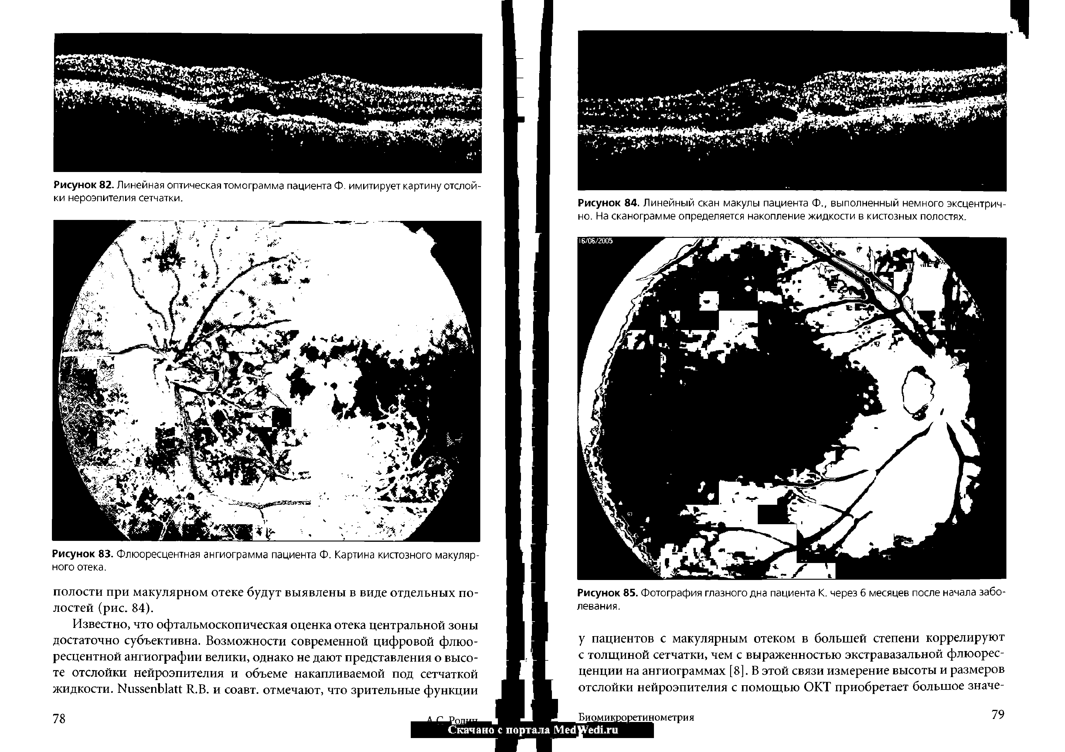 Рисунок 84. Линейный скан макулы пациента Ф., выполненный немного эксцентрично. На сканограмме определяется накопление жидкости в кистозных полостях.