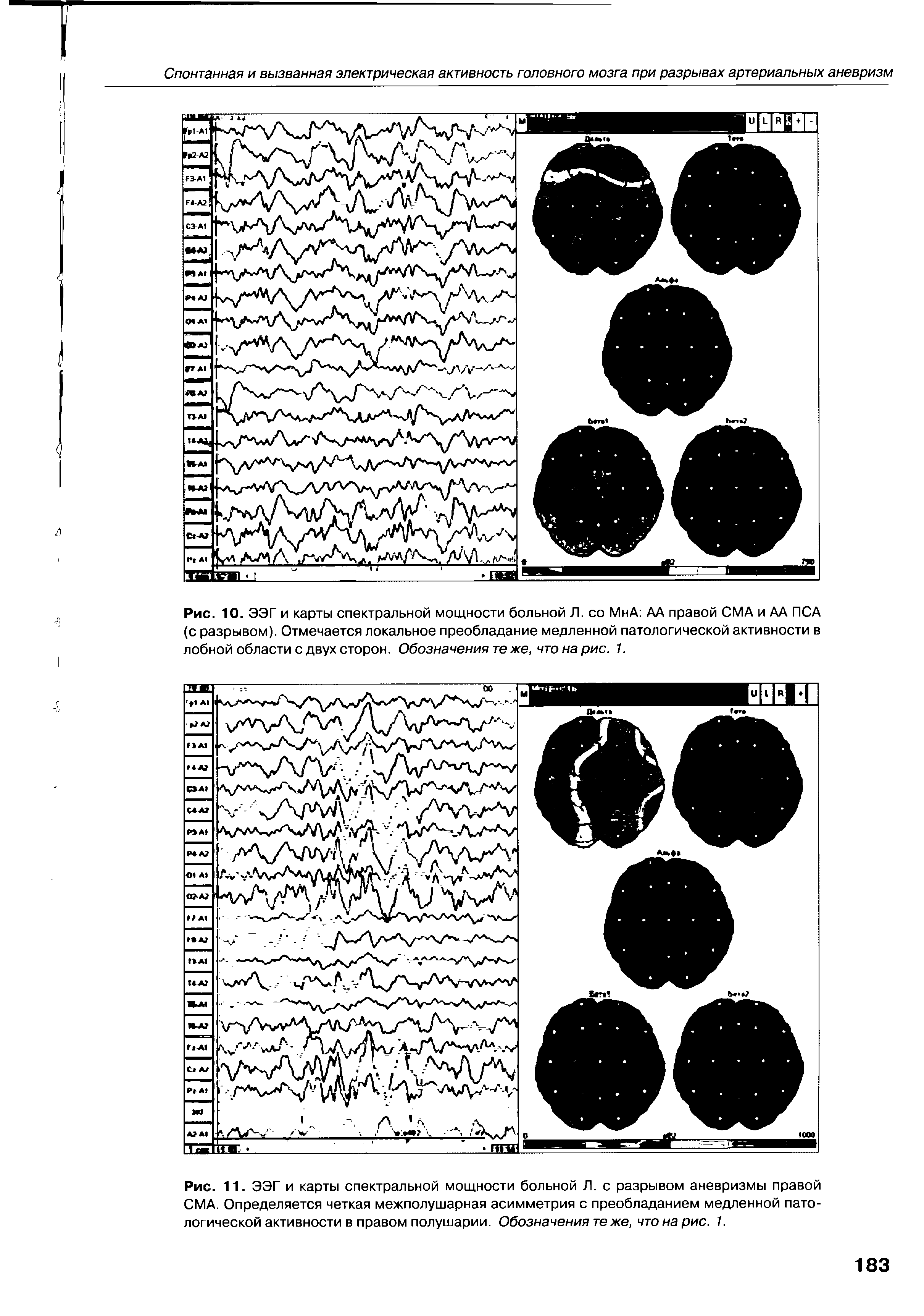 Рис. 10. ЭЭГ и карты спектральной мощности больной Л. со МнА АА правой СМА и АА ПСА (с разрывом). Отмечается локальное преобладание медленной патологической активности в лобной области с двух сторон. Обозначения те же, что на рис. 1.