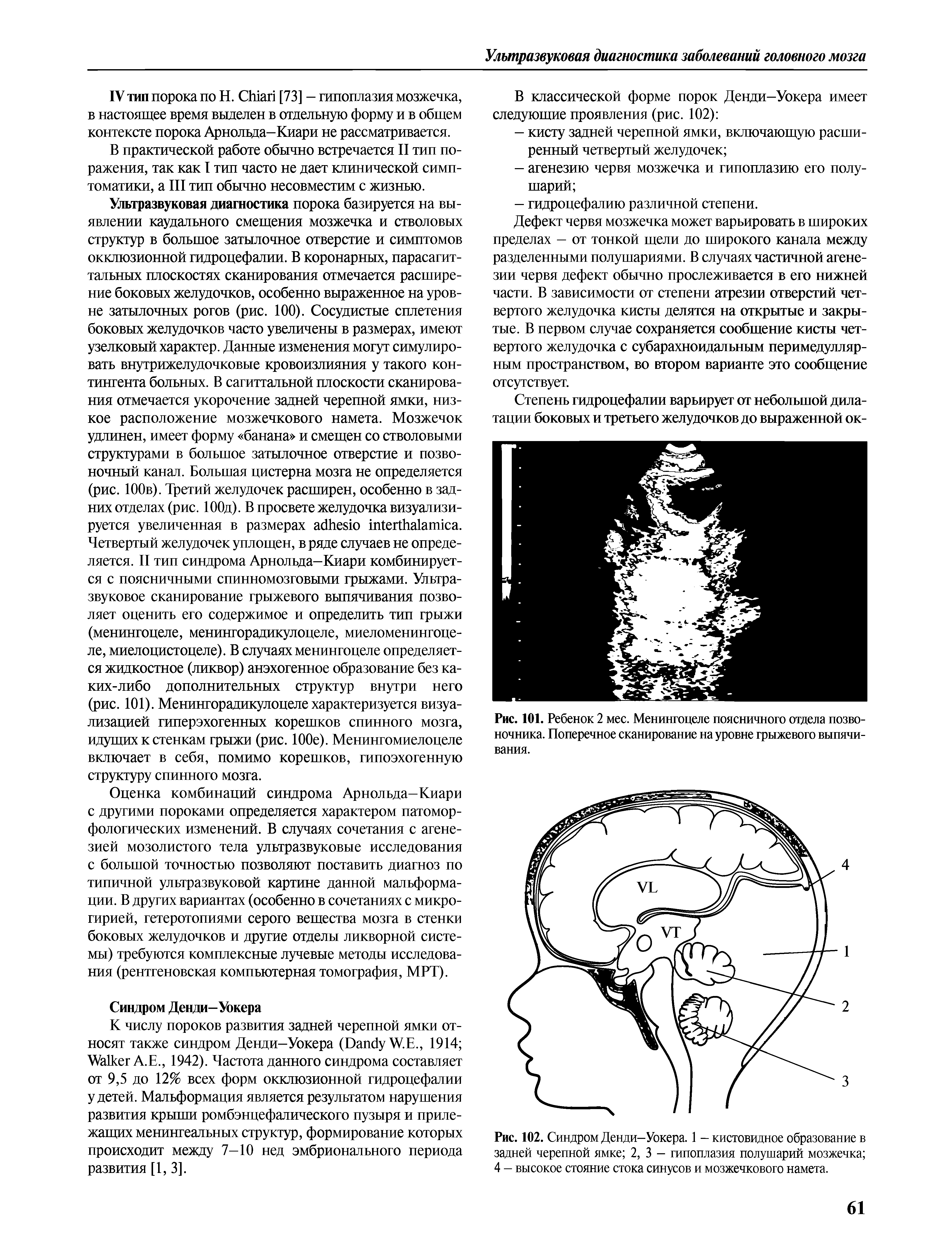 Рис. 102. Синдром Денди-Уокера. 1 - кистовидное образование в задней черепной ямке 2, 3 - гипоплазия полушарий мозжечка 4 — высокое стояние стока синусов и мозжечкового намета.