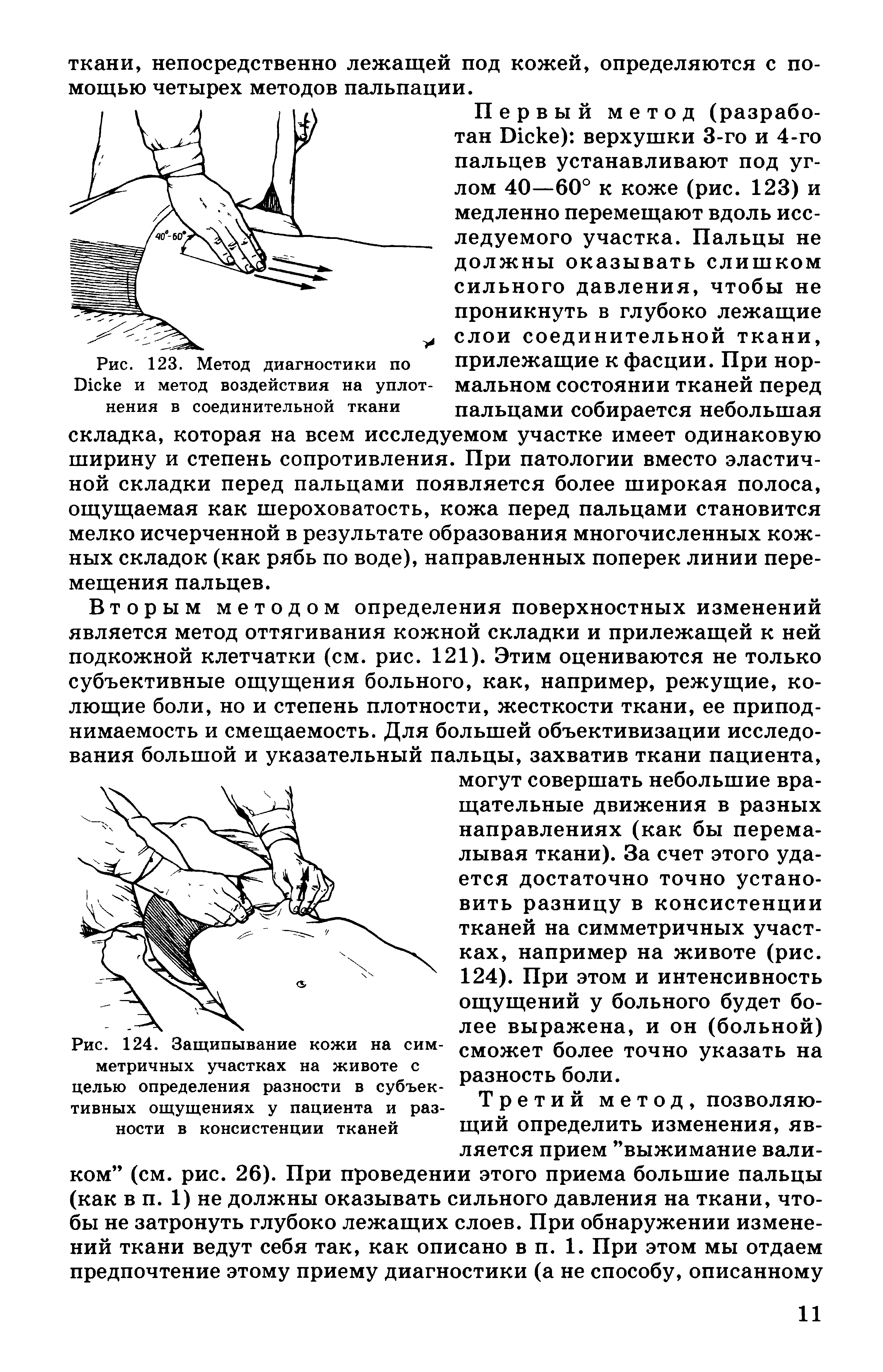 Рис. 124. Защипывание кожи на метричных участках на животе с целью определения разности в субъективных ощущениях у пациента и разности в консистенции тканей...