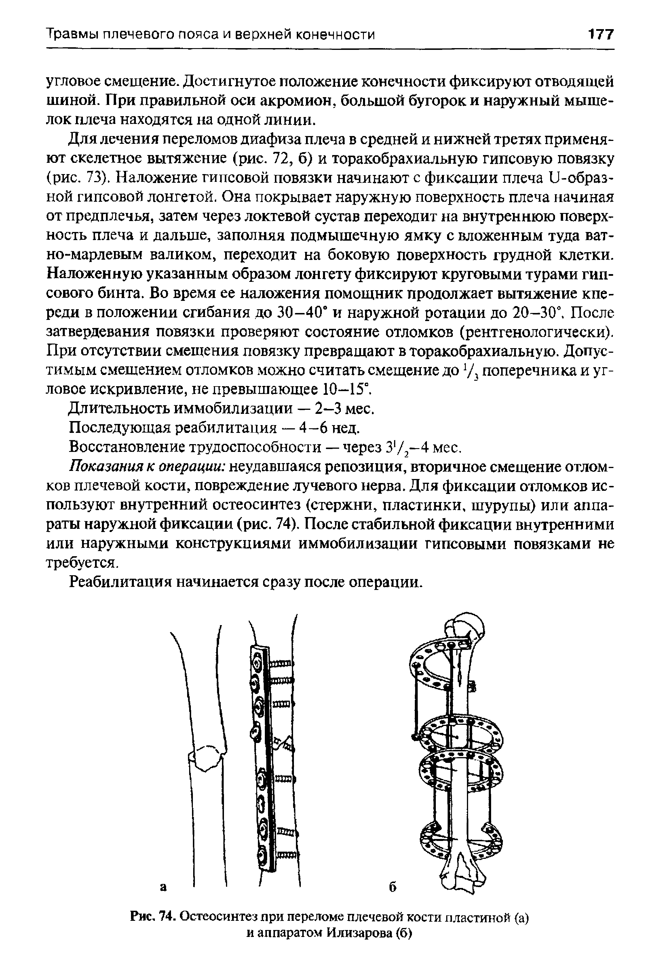 Рис. 74. Остеосинтез при переломе плечевой кости пластиной (а) и аппаратом Илизарова (б)...